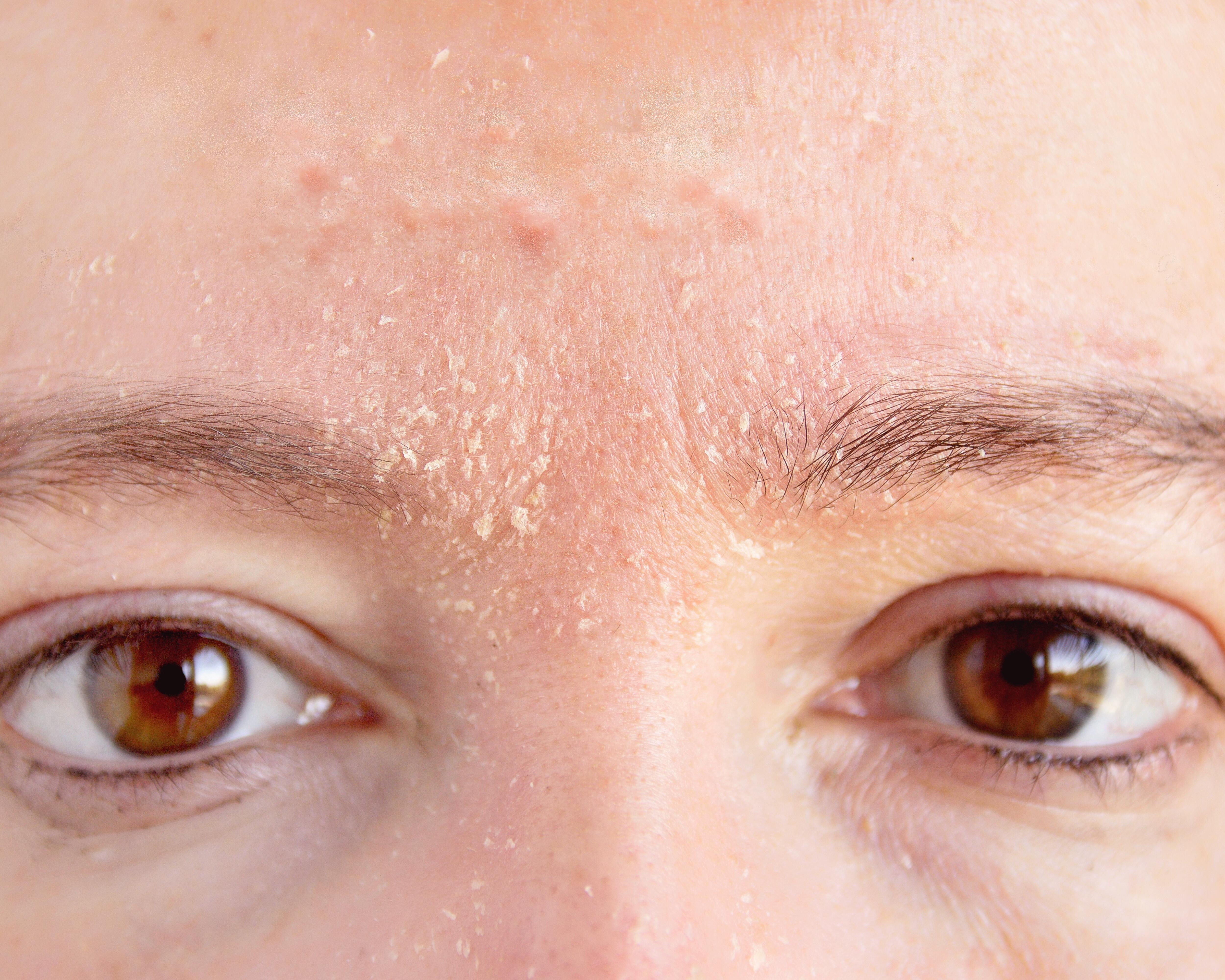 AV_carnets-experts_acne_xerose-induite_5x4