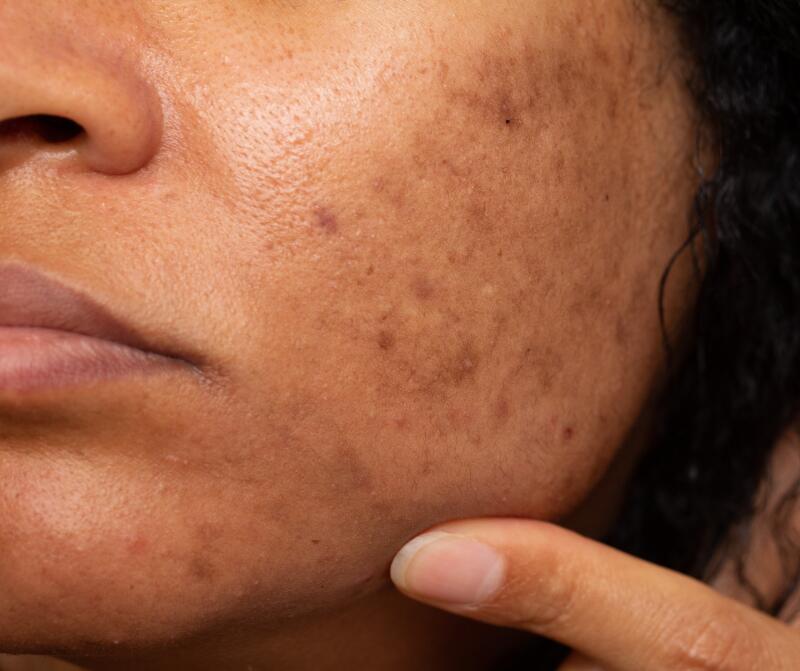 Las manchas oscuras en la piel | Ducray
