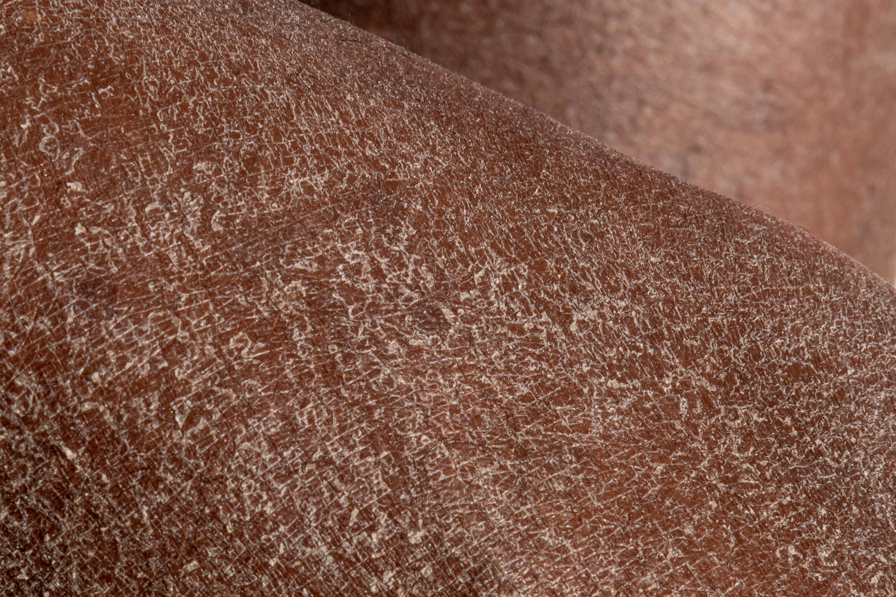 Understanding and Treating Dry Skin: Causes and Symptoms