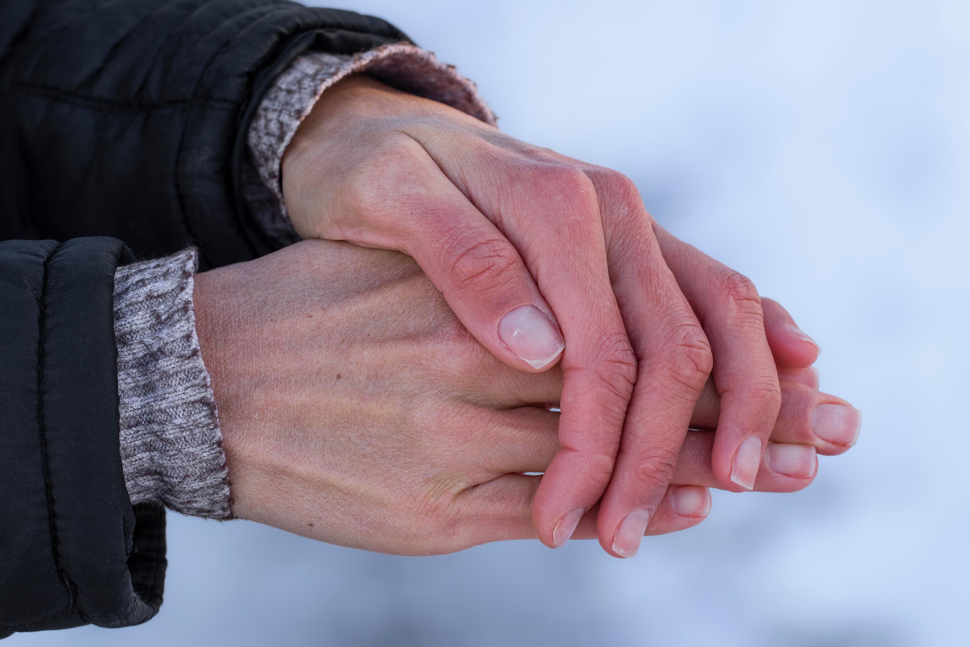 Mains sèches et rougies par le froid