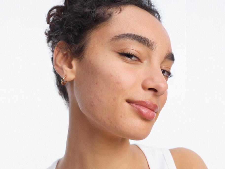 Acne and related disorders <i>Hidradenitis suppurativa</i>