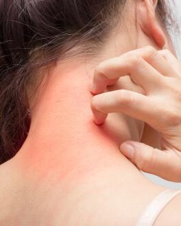 Cos’è l’eczema ?