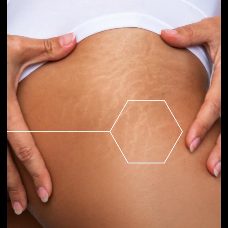 Έλαιο για μασάζ κατά των δερματικών σημαδιών