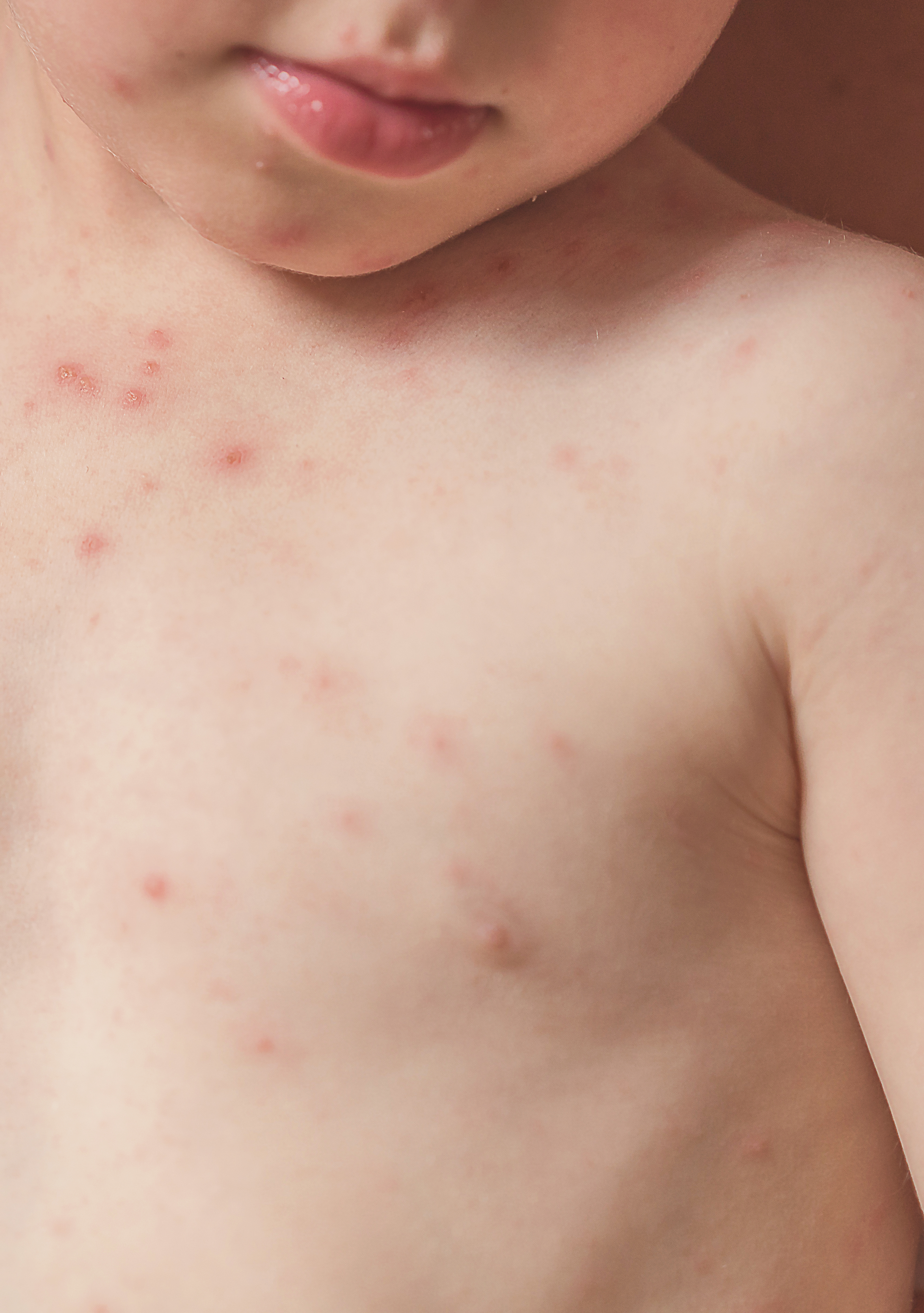 <span class="ezstring-field">av_votre-peau_cicatrisation_irritations-infectieuses_zona_4x5_367x460</span>