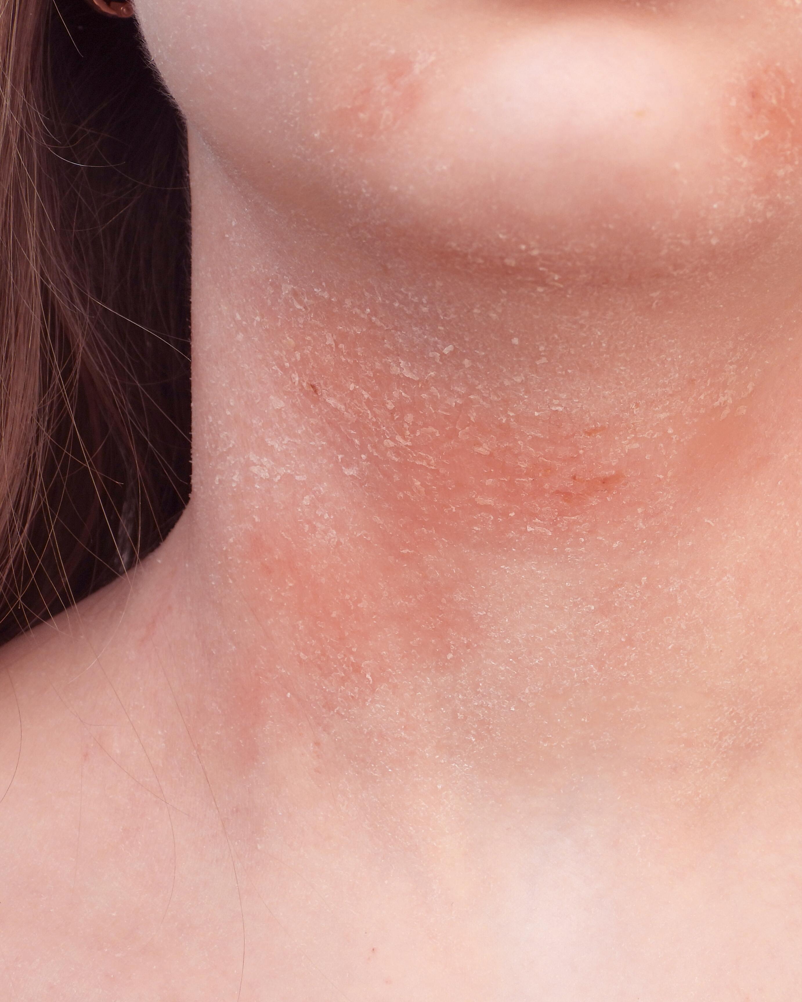 AV_carnets-experts_peau-seche_eczema_4x5