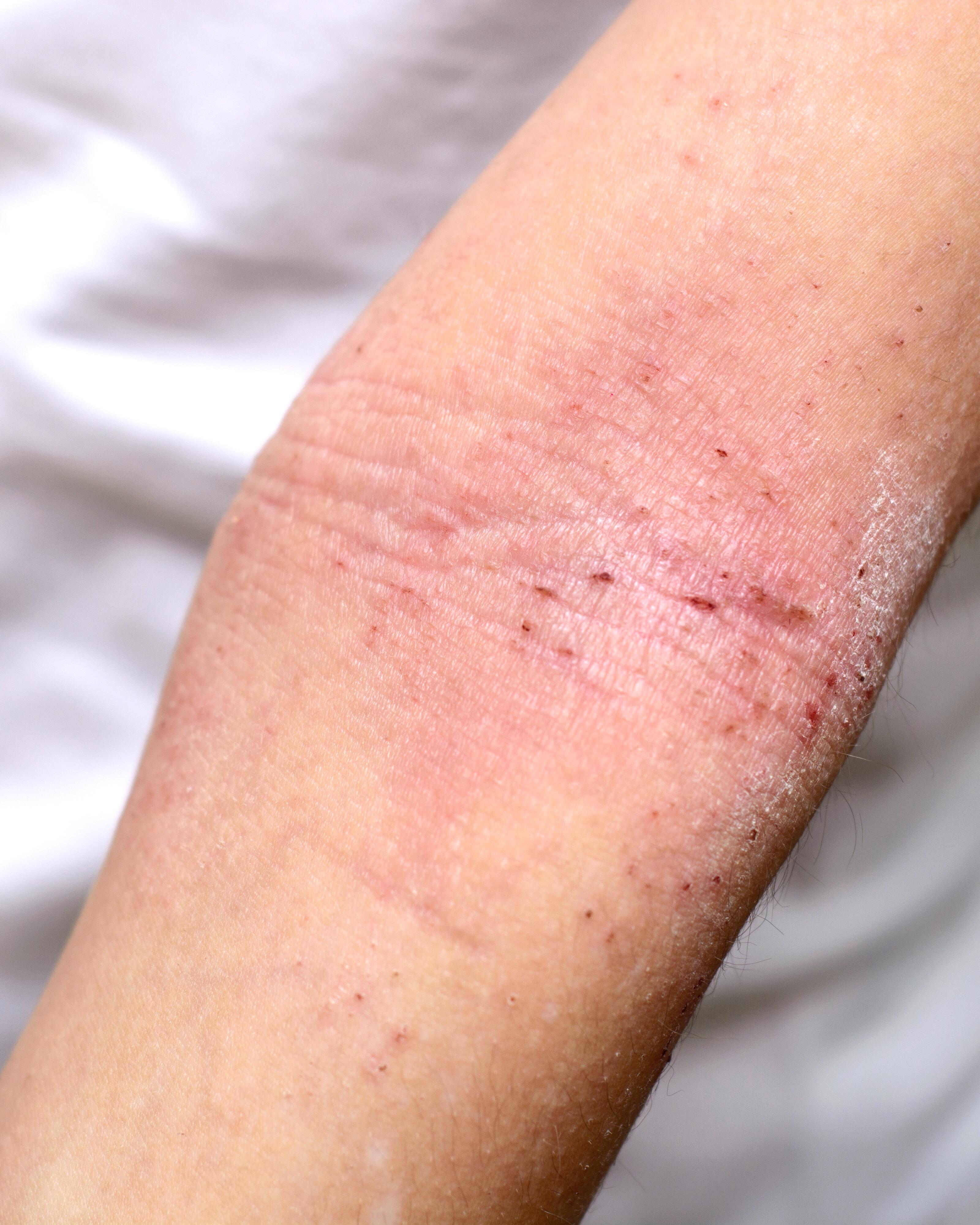 av_carnets-experts_secheresse-deshydratation_xerose-atopic_4x5