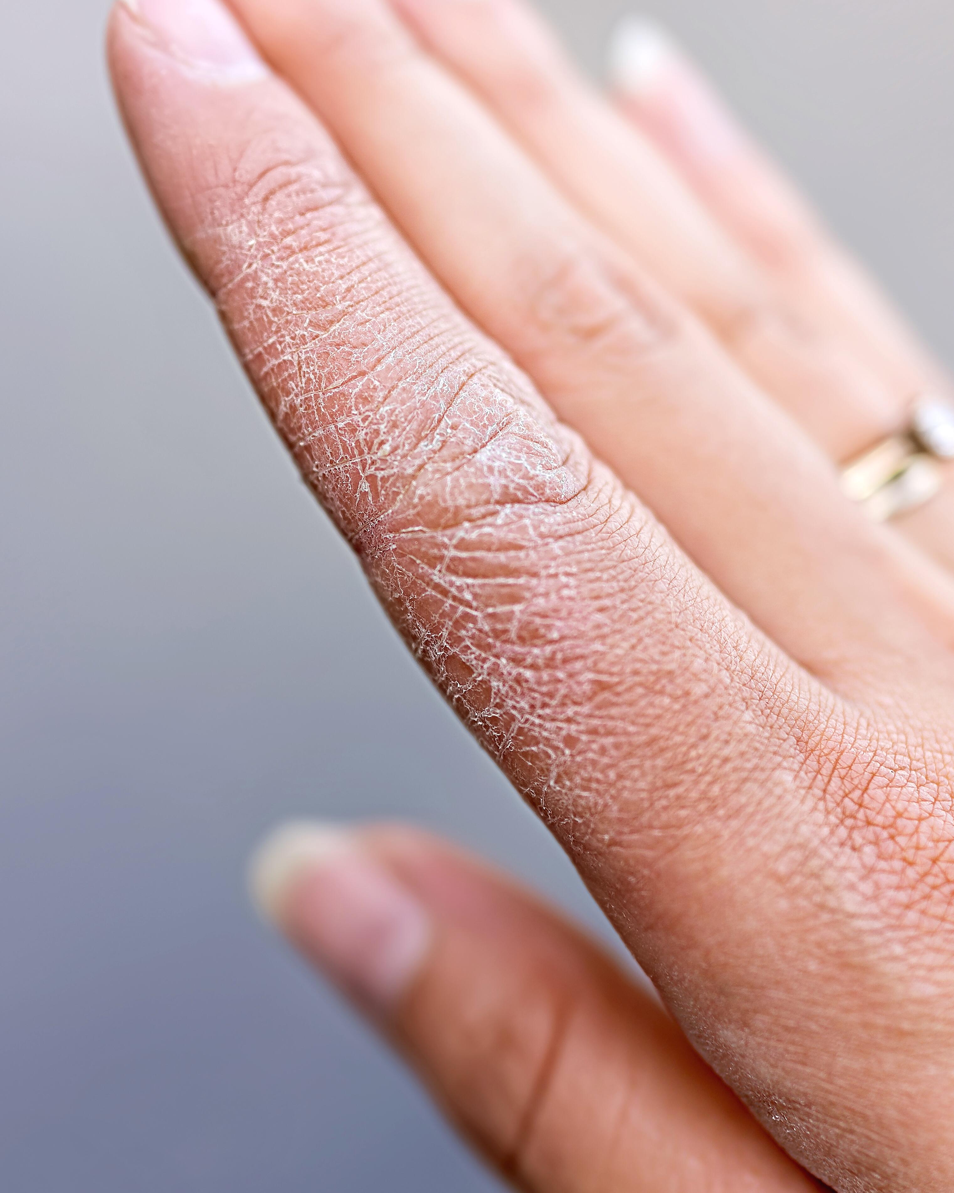 AV_carnets-experts_secheresse-deshydratation_xerose-hivernale_4x5