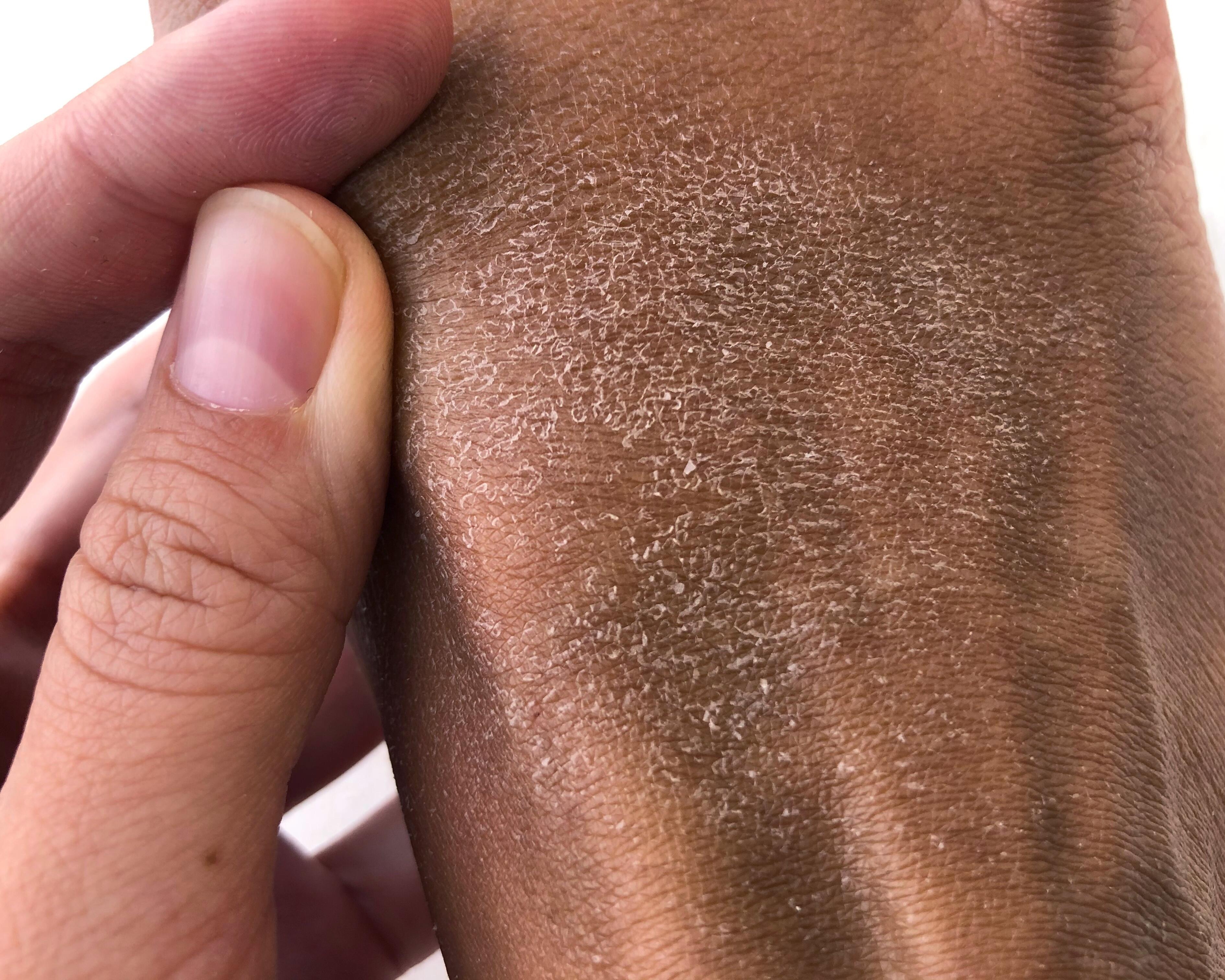 av_carnets-experts_peau-seche_ichtyose_5x4