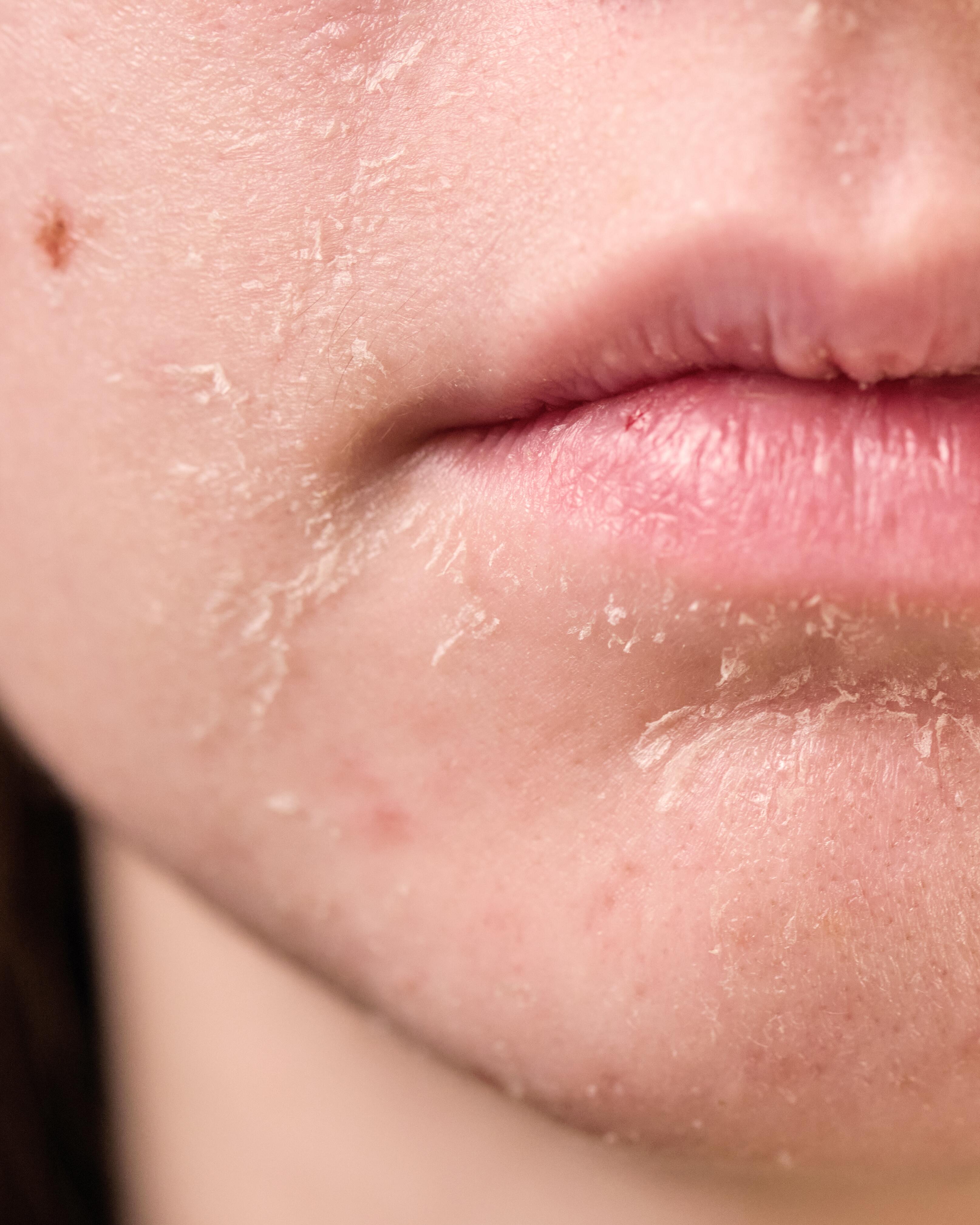 AV_carnets-experts_peau-seche_xerose_4x5