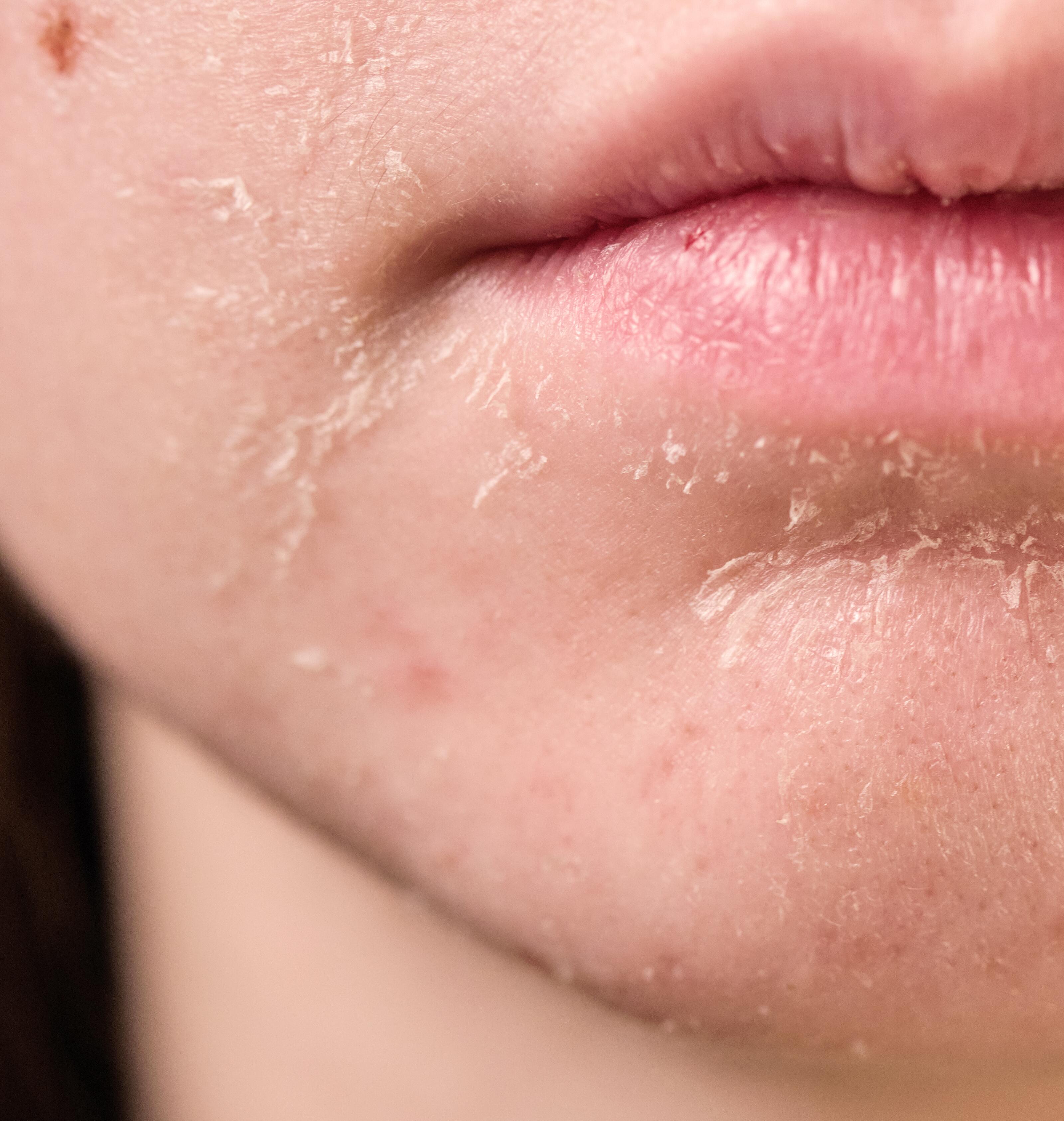 Piel seca | causas la resequedad en la piel