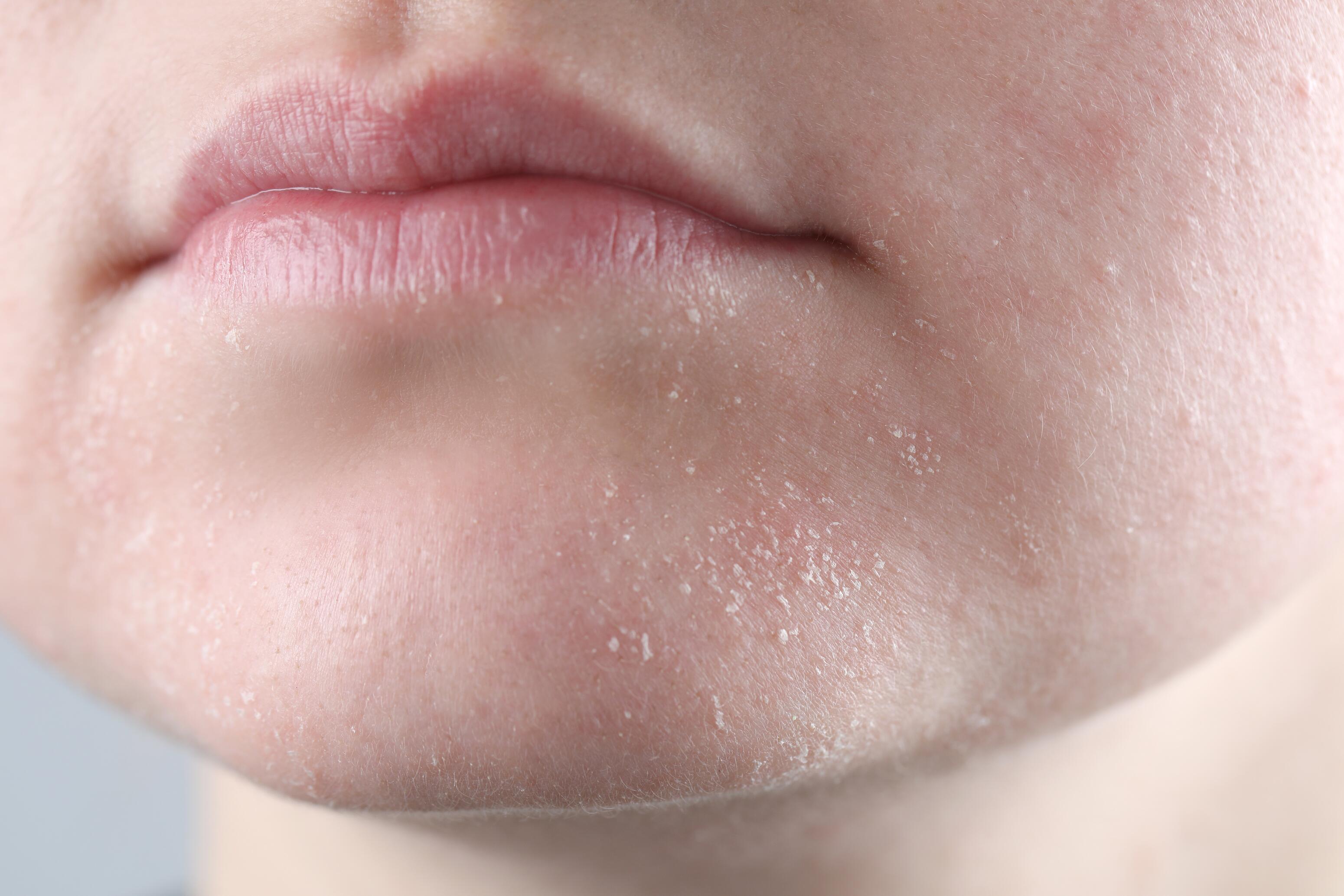 Piel seca del rostro: Cuidados, prevención y consejos