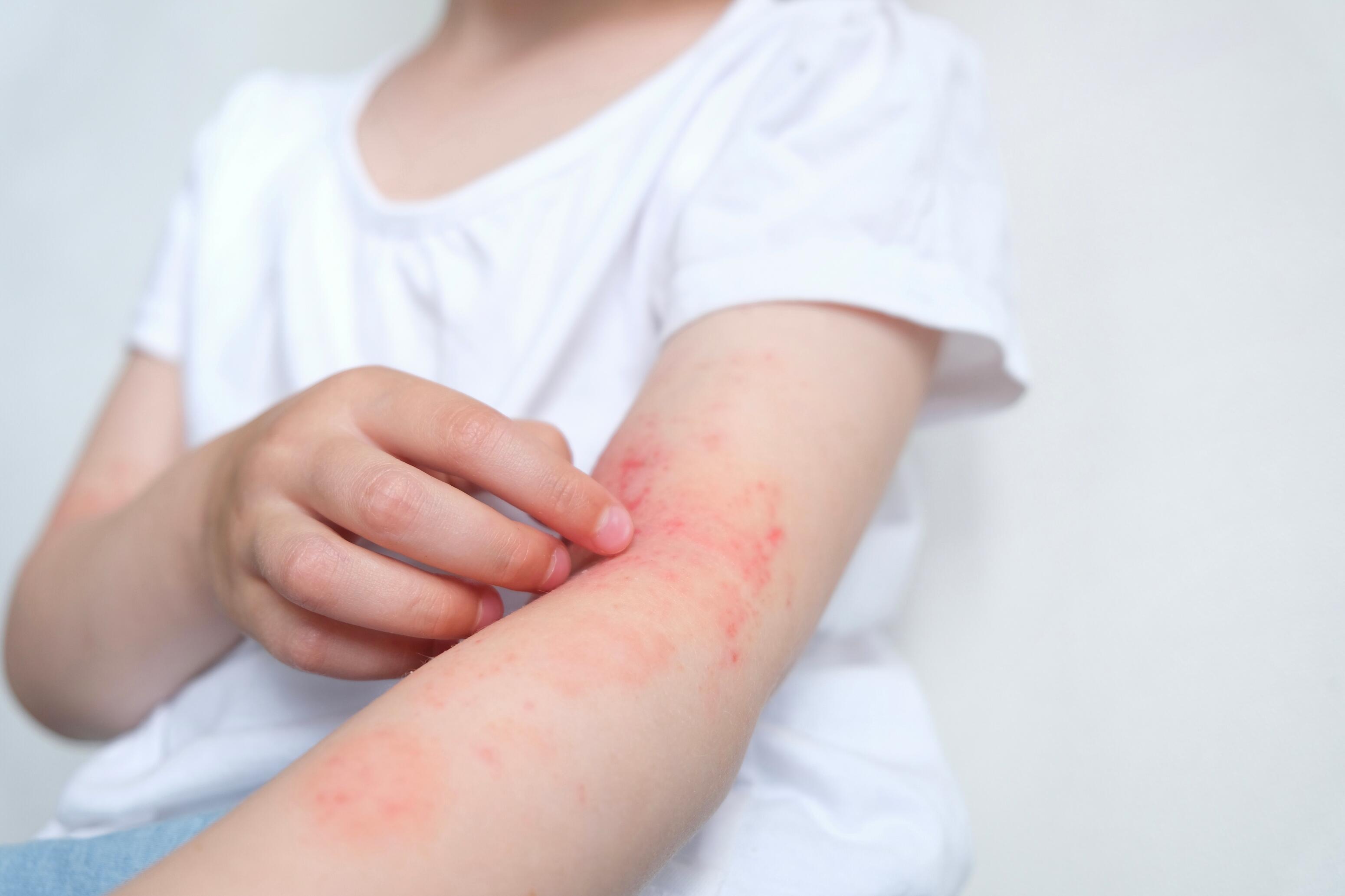 Wysypka alergiczna - jak rozpoznać i sobie z nią radzić?