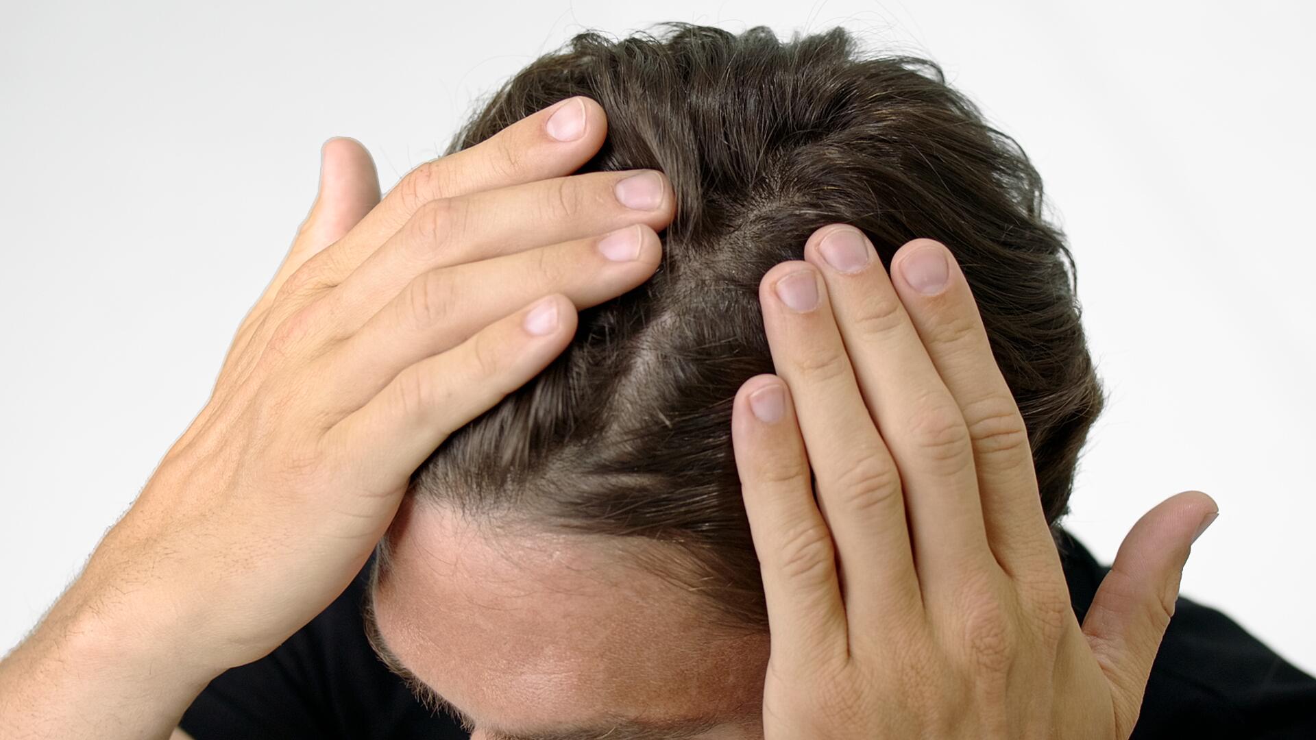 Caída del cabello en los hombres