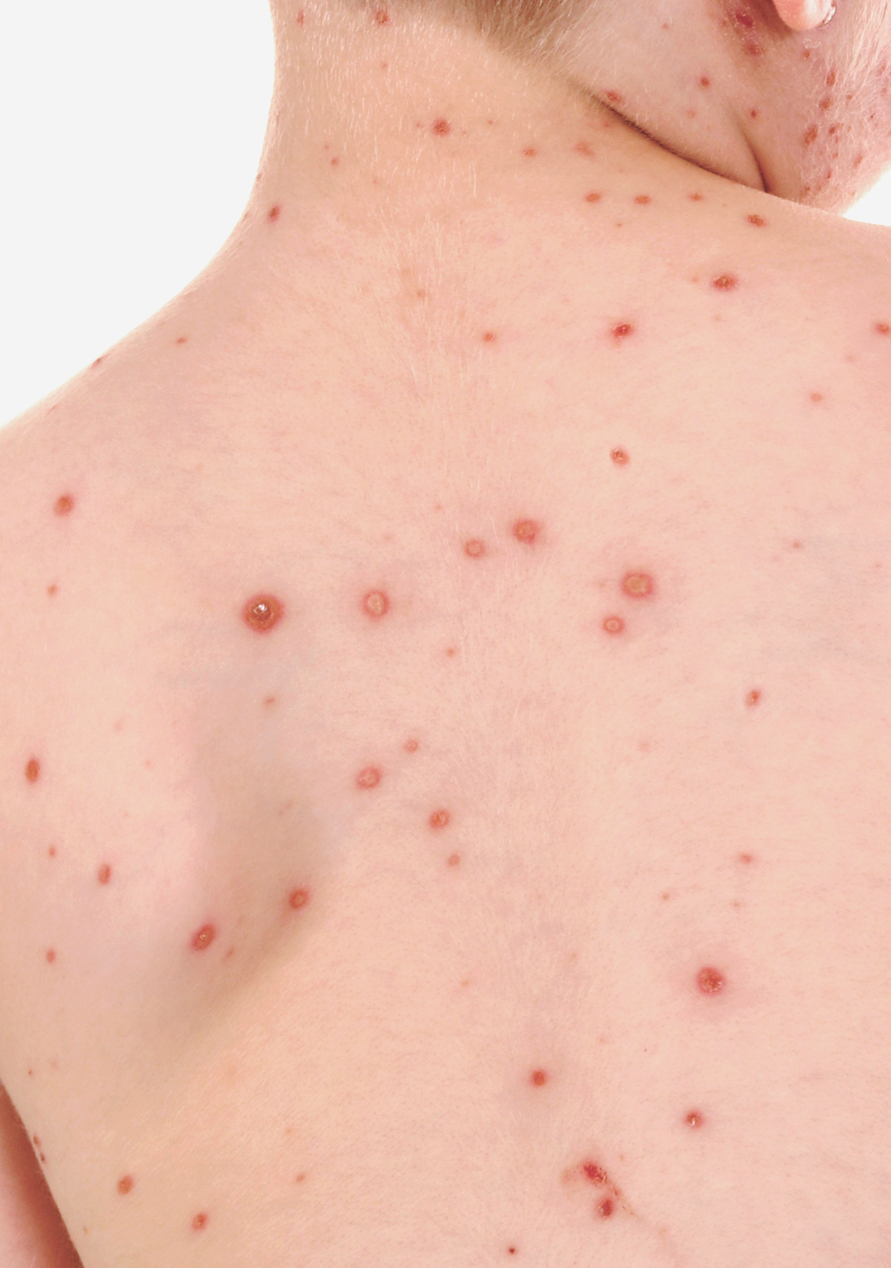 <span class="ezstring-field">av_votre-peau_cicatrisation_irritations-infectieuses_varicelle_4x5_367x460</span>