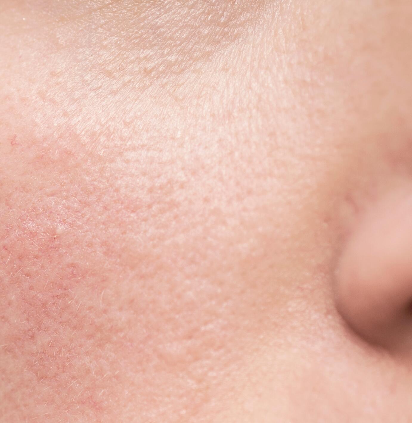 Boutons sur le visage : identification, causes et comment les traiter ? -  Matière Brute Lab