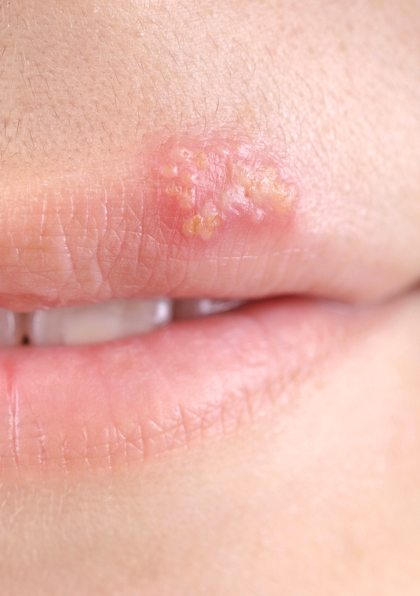 <span class="ezstring-field">av_votre-peau_cicatrisation_irritations-infectieuses_herpes_4x5_367x460</span>