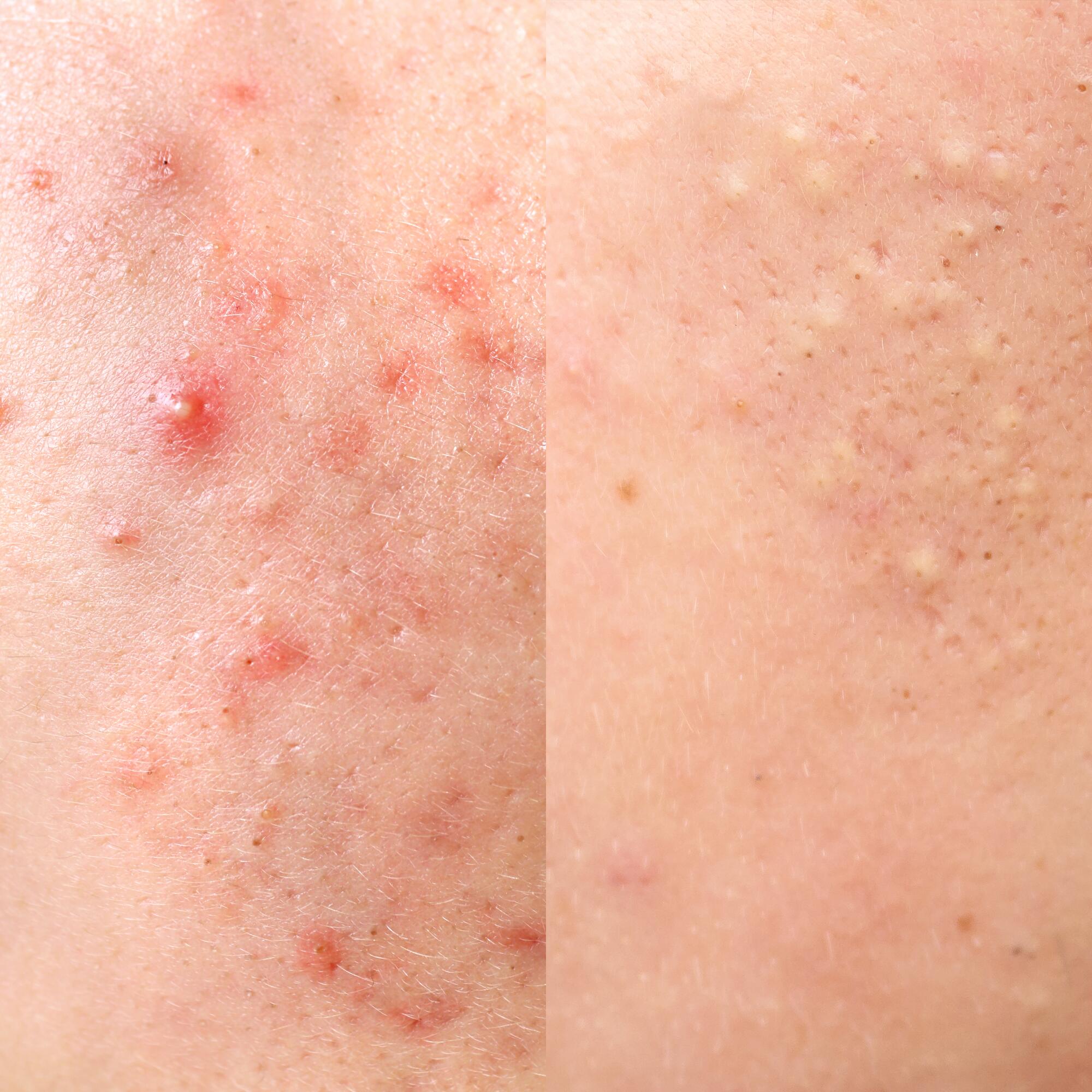 av_acne_types_inflammatoire_retentionnelle_1x1