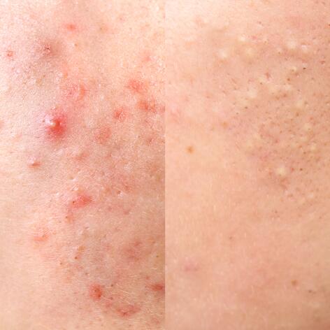 Retentional and inflammatory acne
