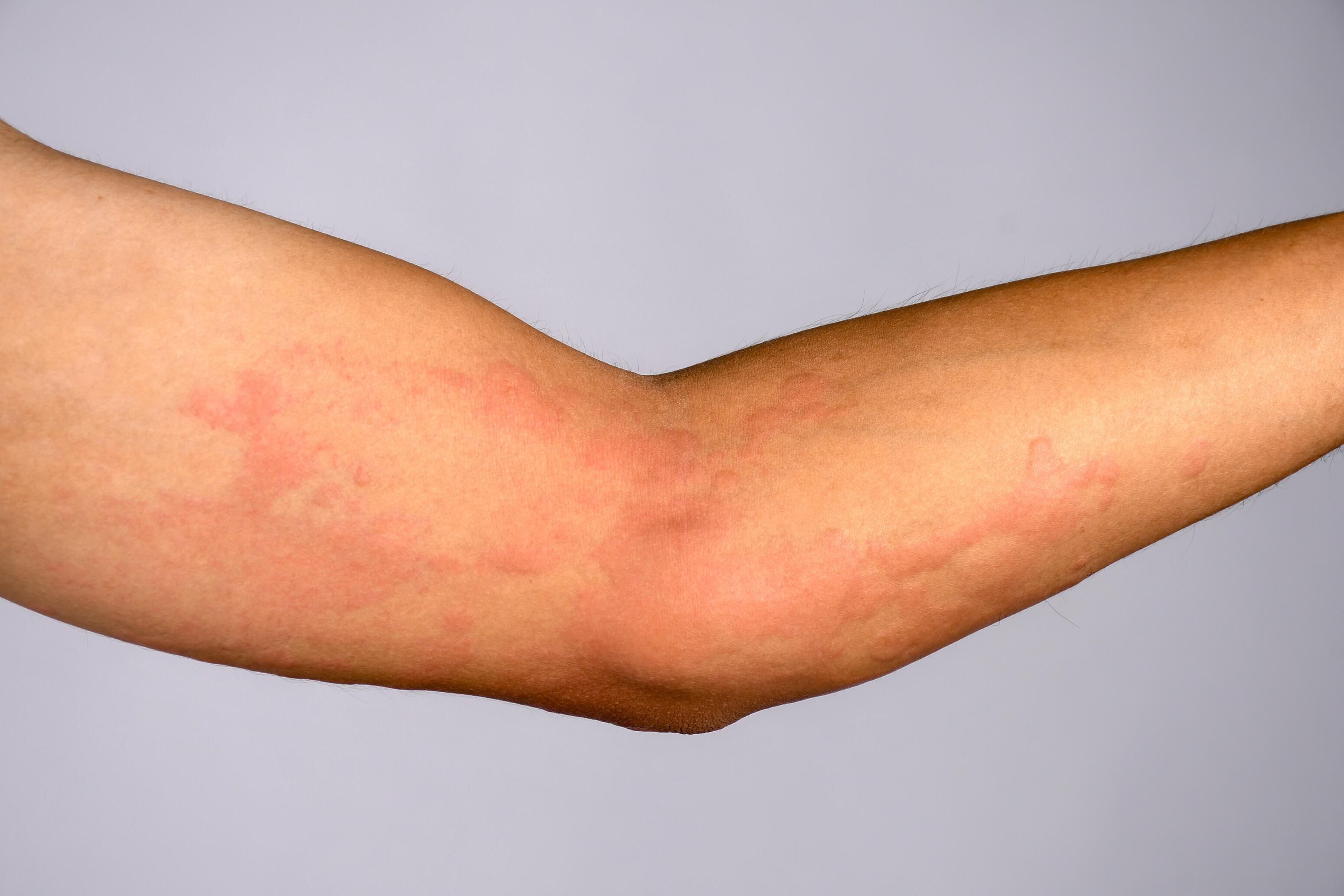 Arms with redness due to urticaria