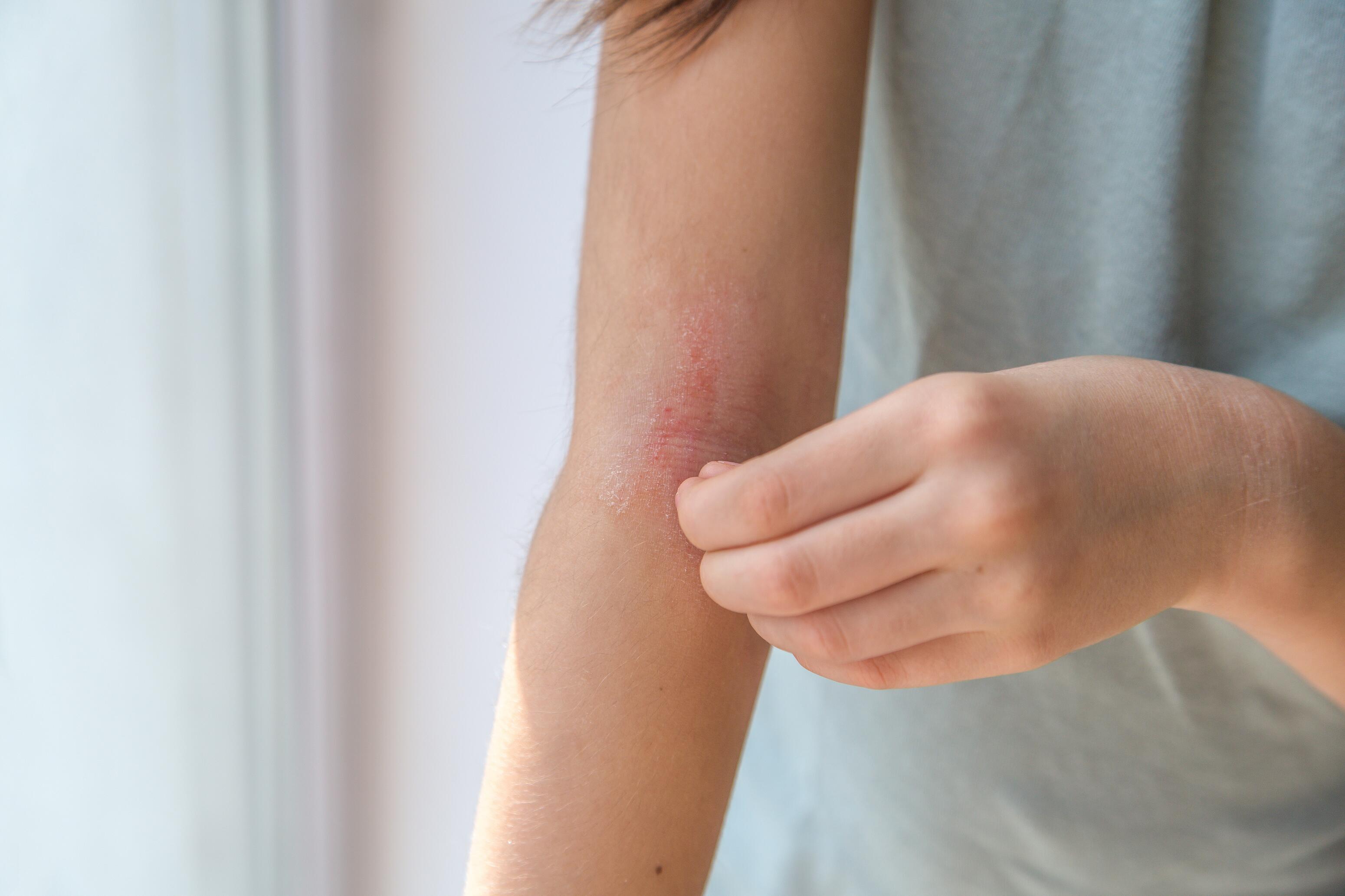 Eczema on Arms and Elbows: Managing Symptoms & Care for Folds