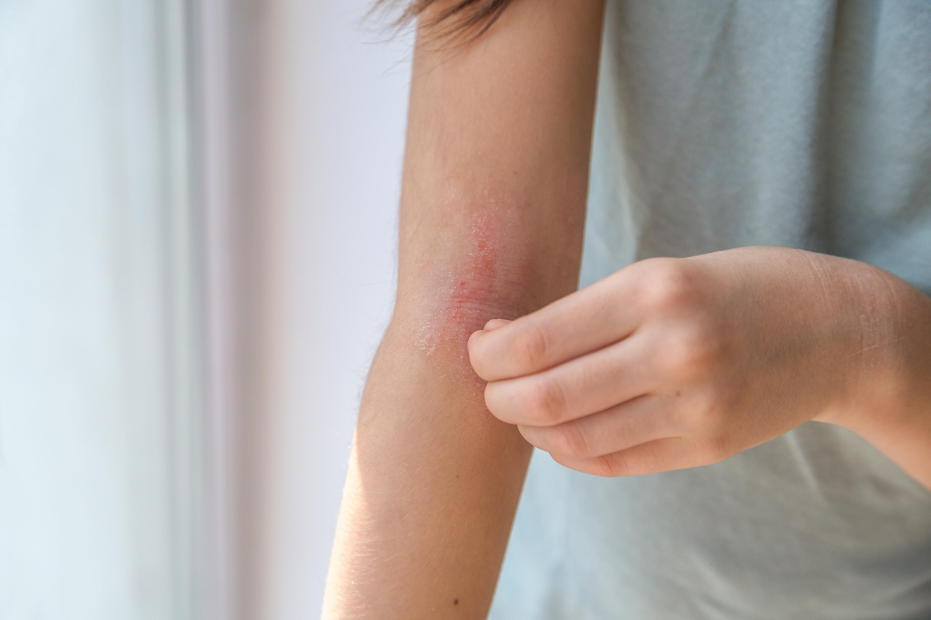 eczema-pliegue-brazo-rascado-niño