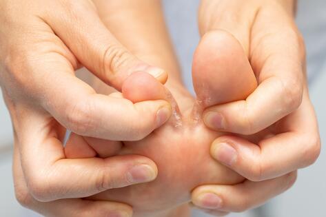 Foot with fungal infection between the toes