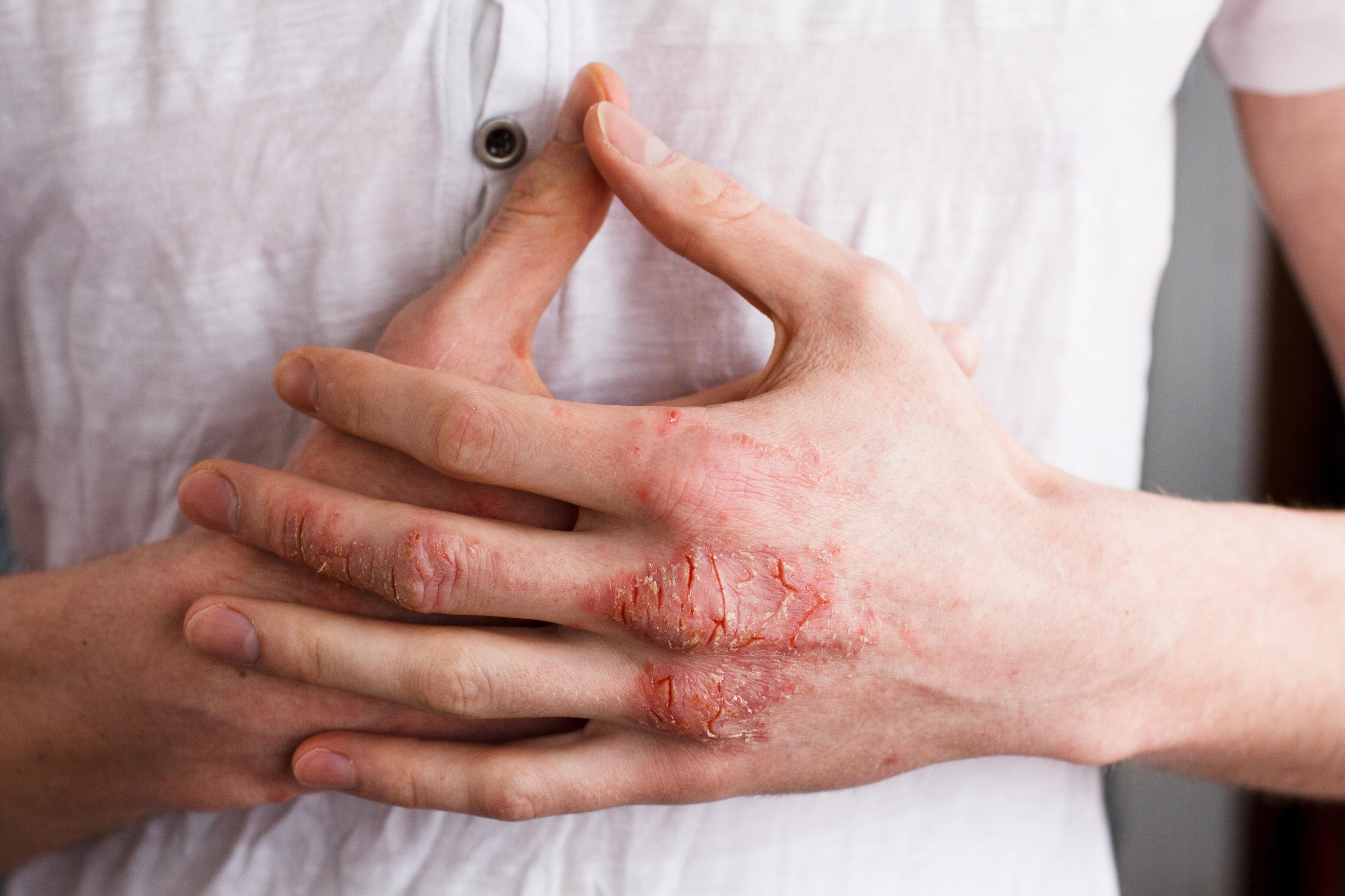 Hands with nummular eczema on the back creating dryness and itching