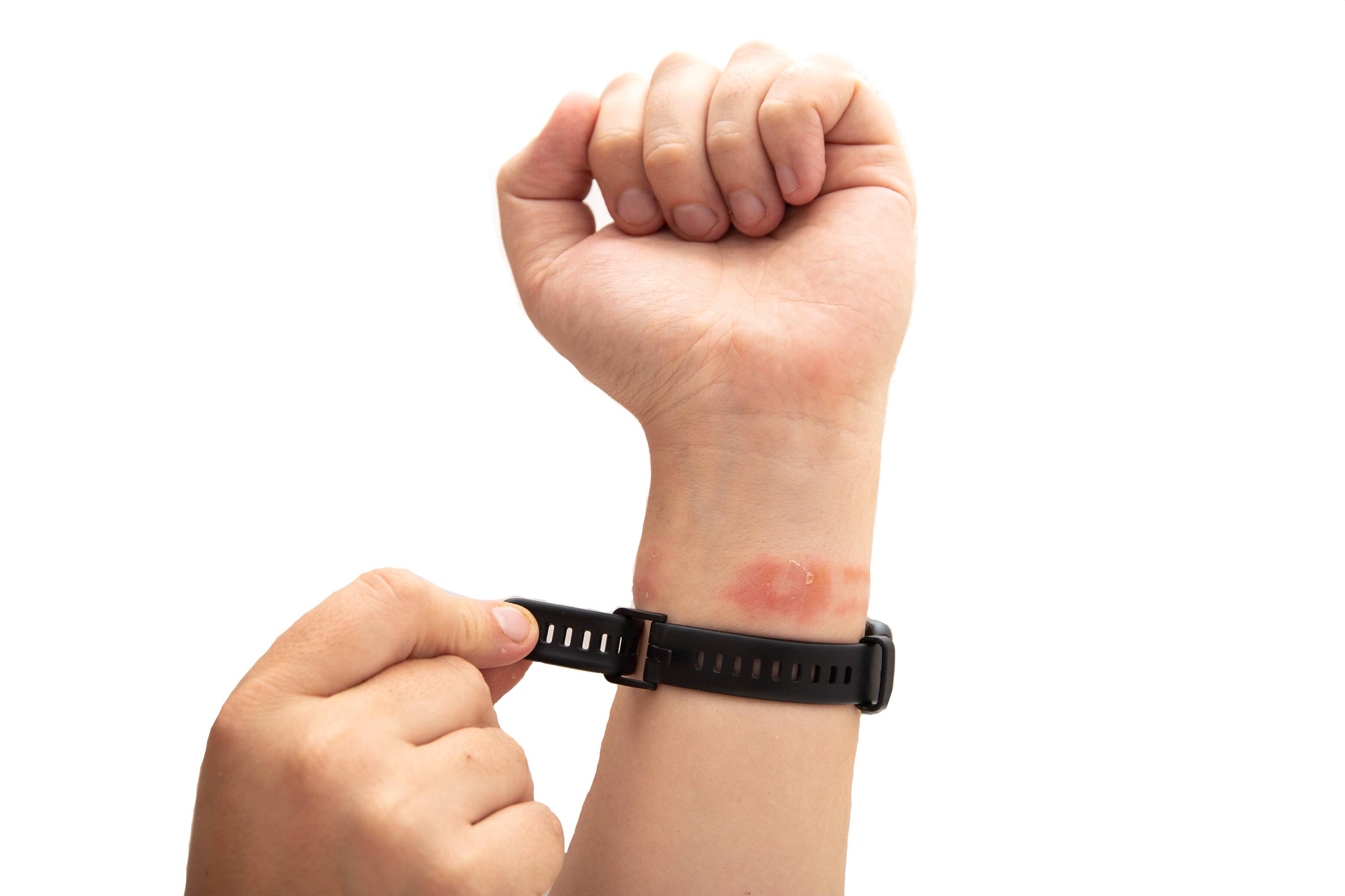 eczema-contacto-alergia-muñeca