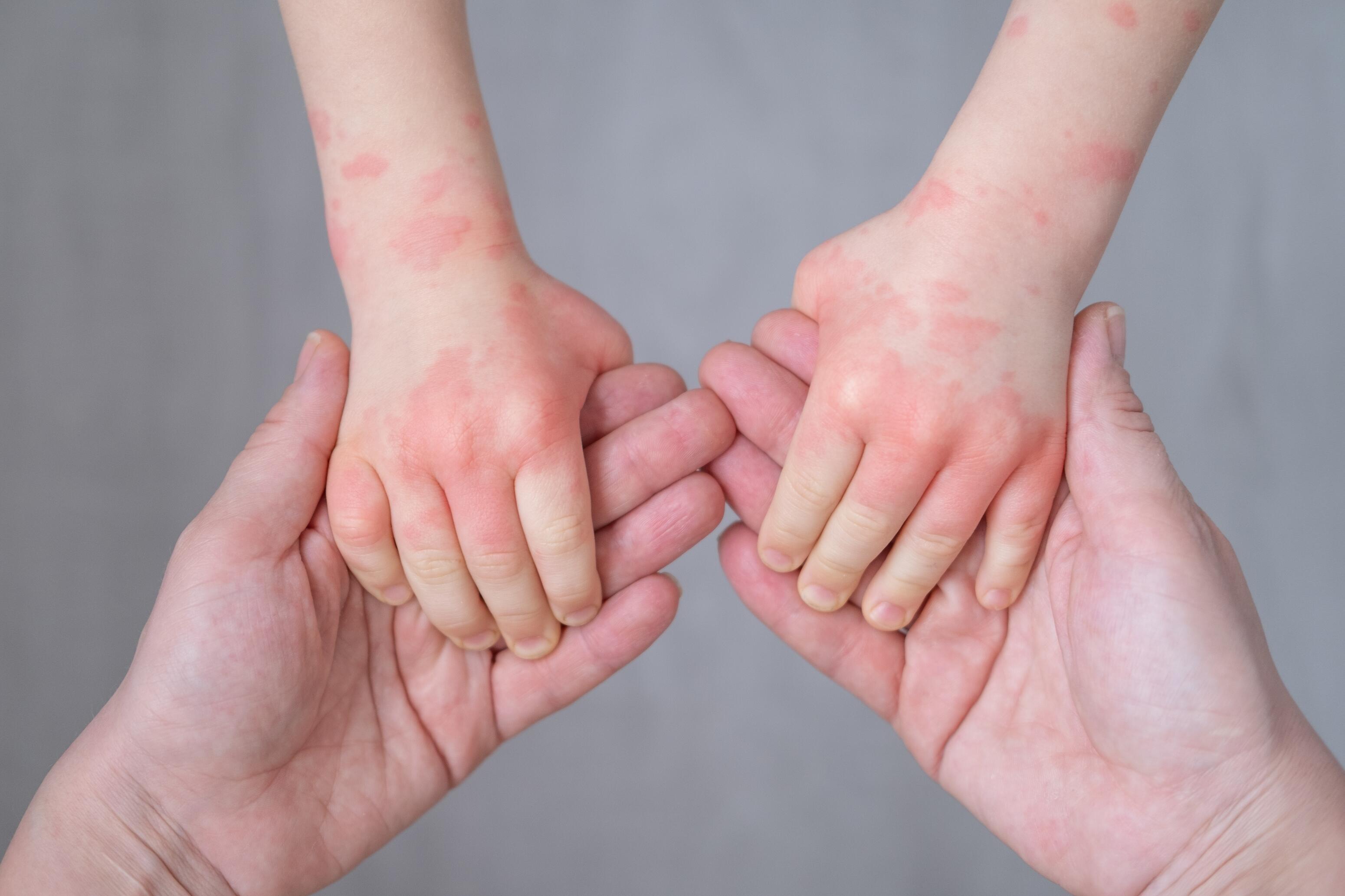 Mother holding her child's atopic hands