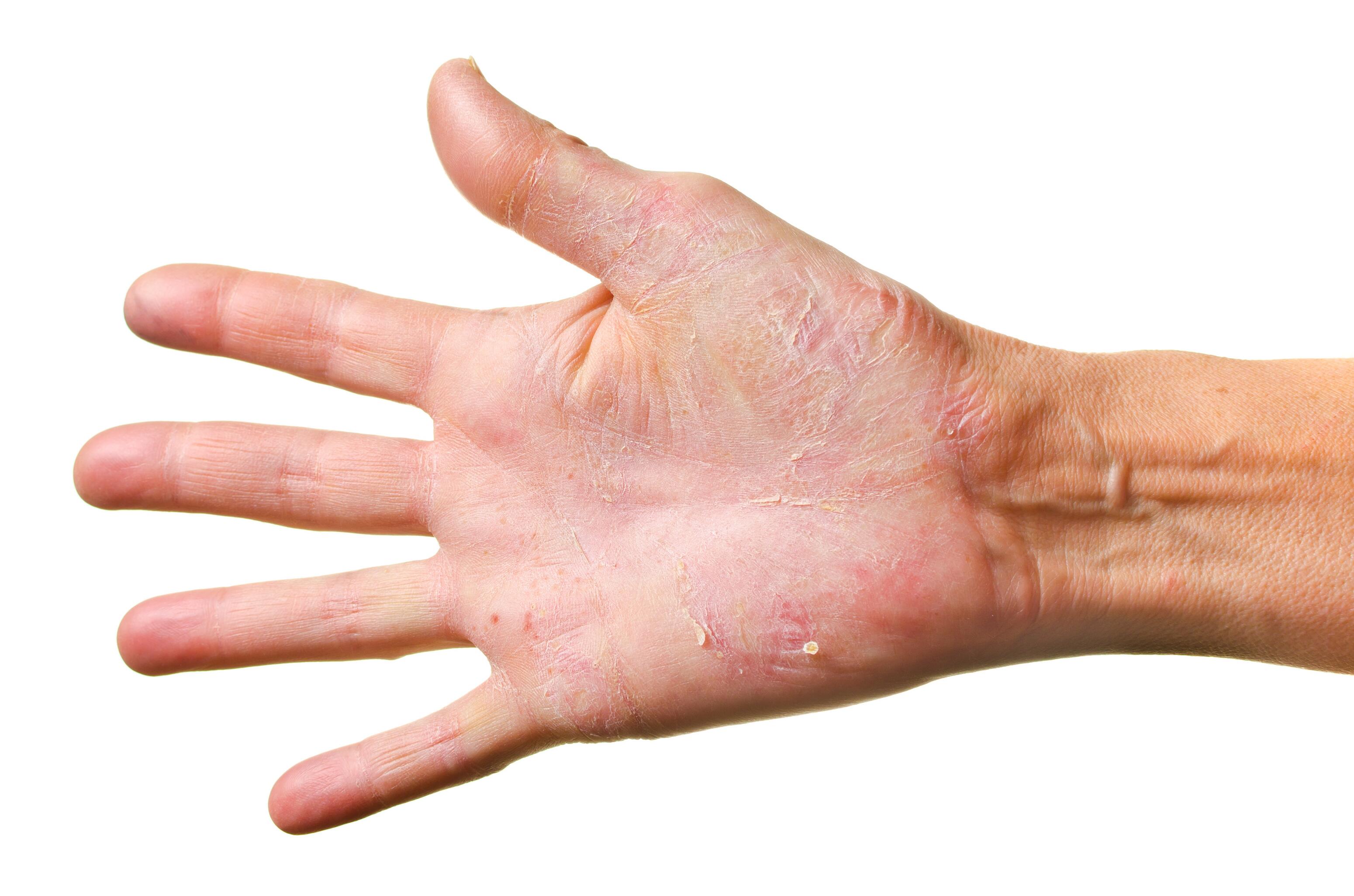 Hand with allergic contact eczema