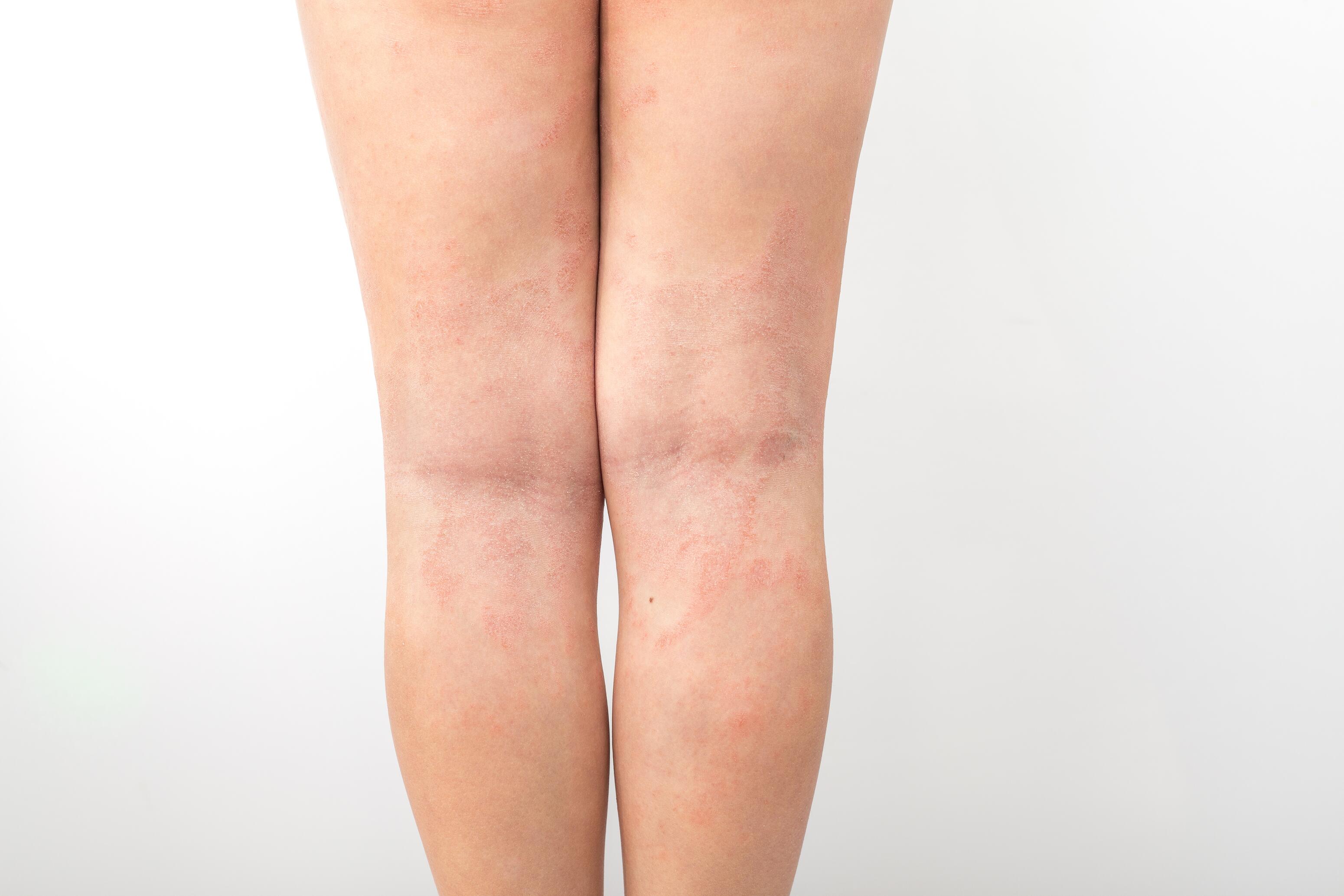 Child with eczema in the folds of the knees
