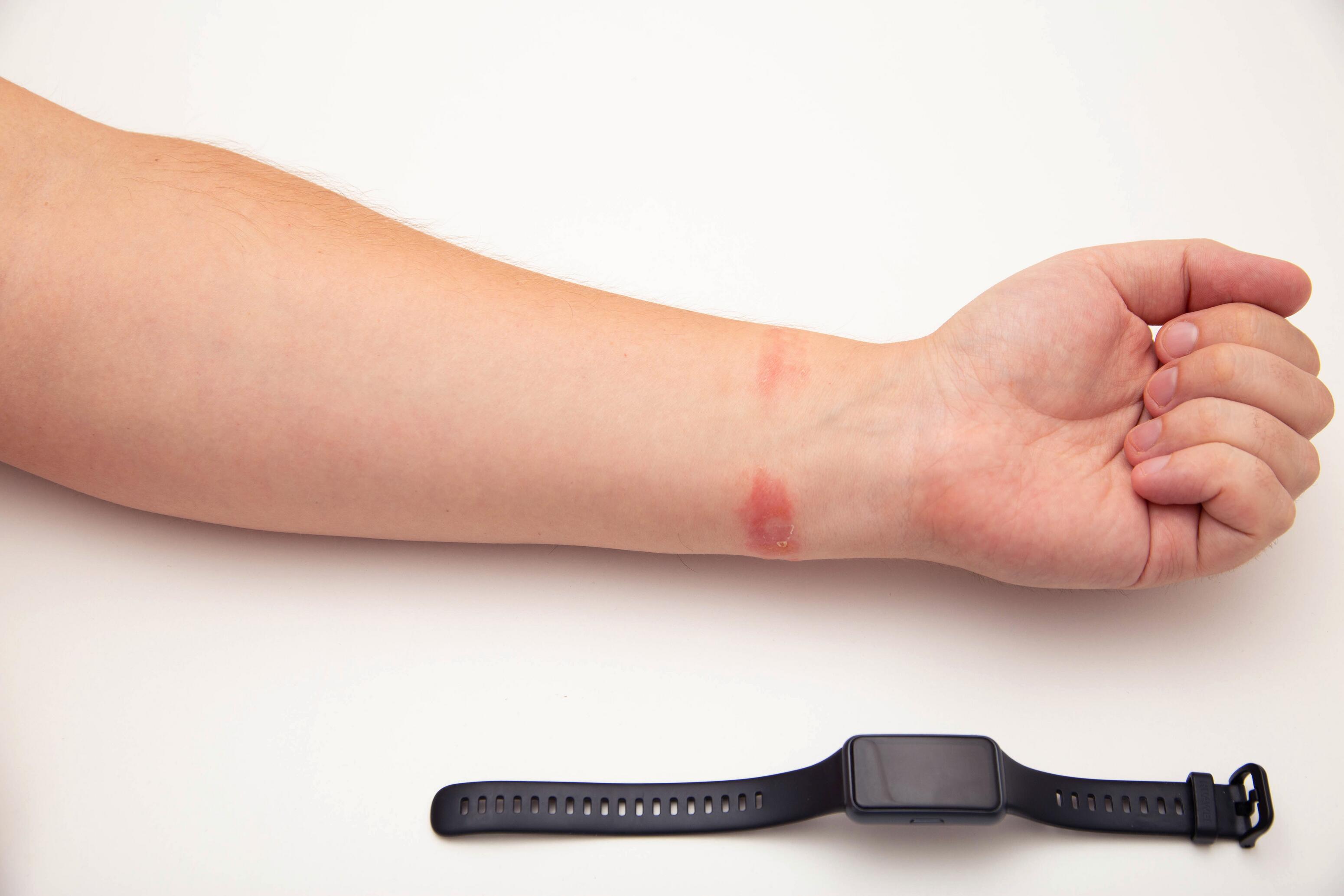 eczema-contact-arm-wrist