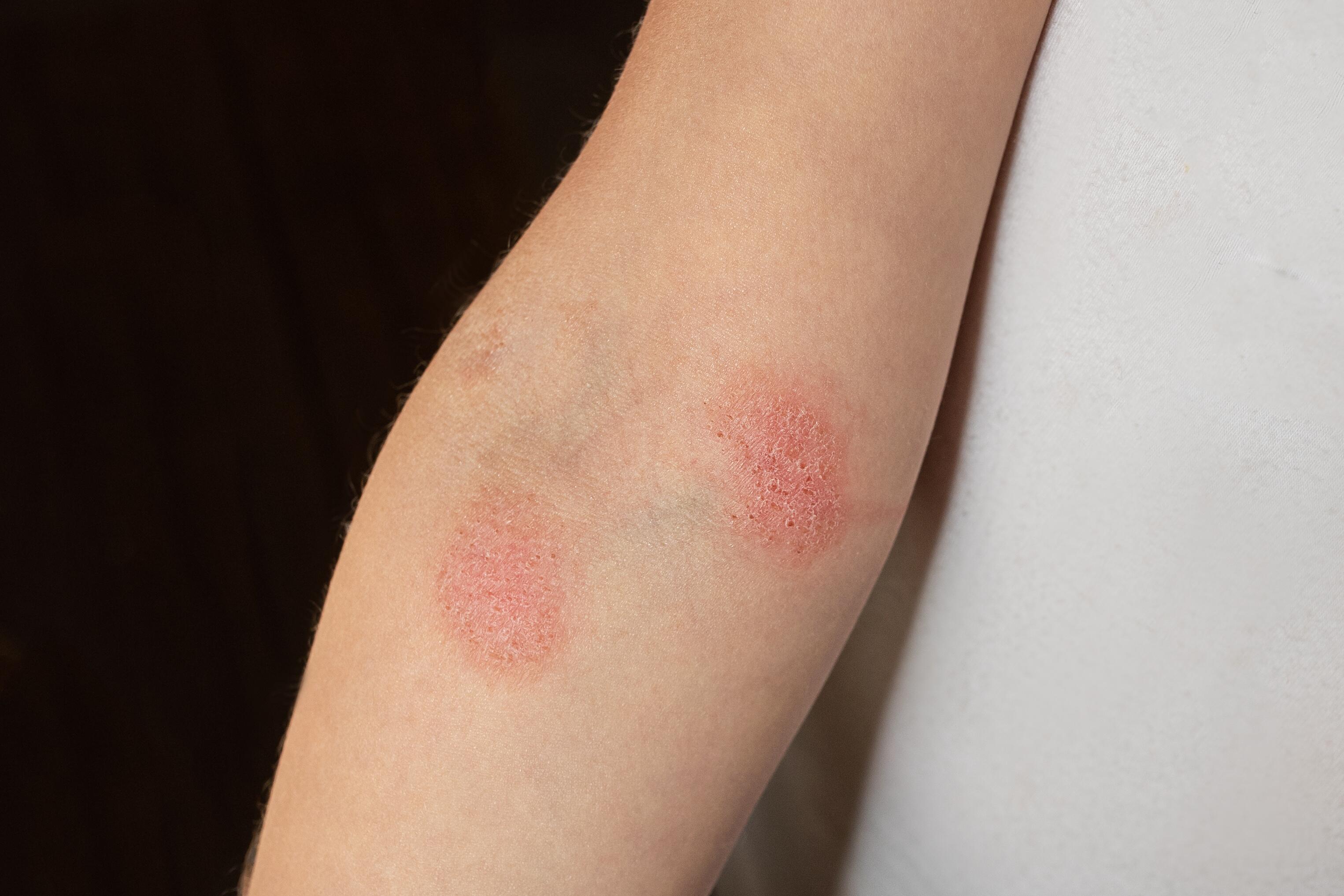 eczema-piel-hongo-infección