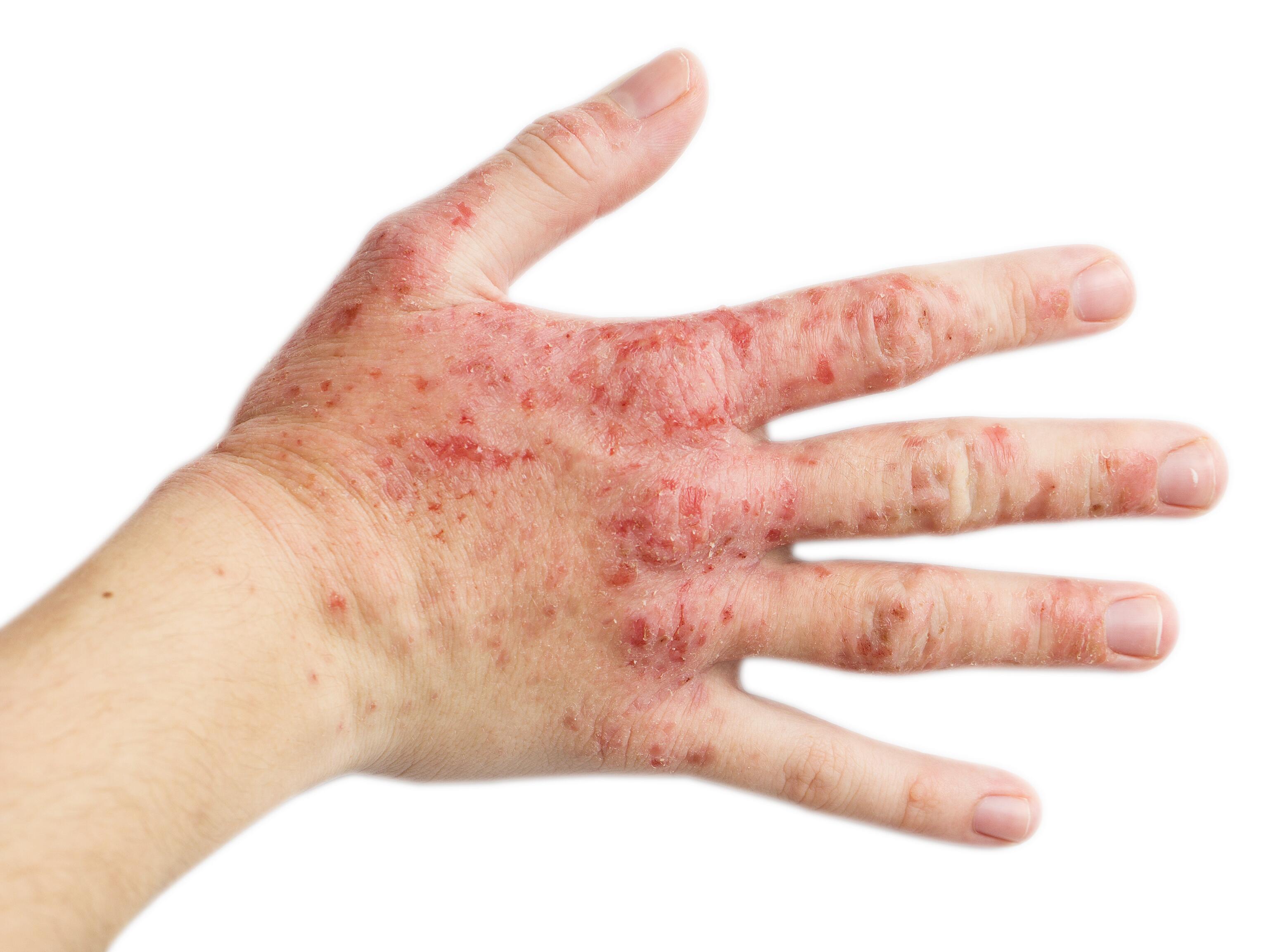 Hand with irritant contact eczema