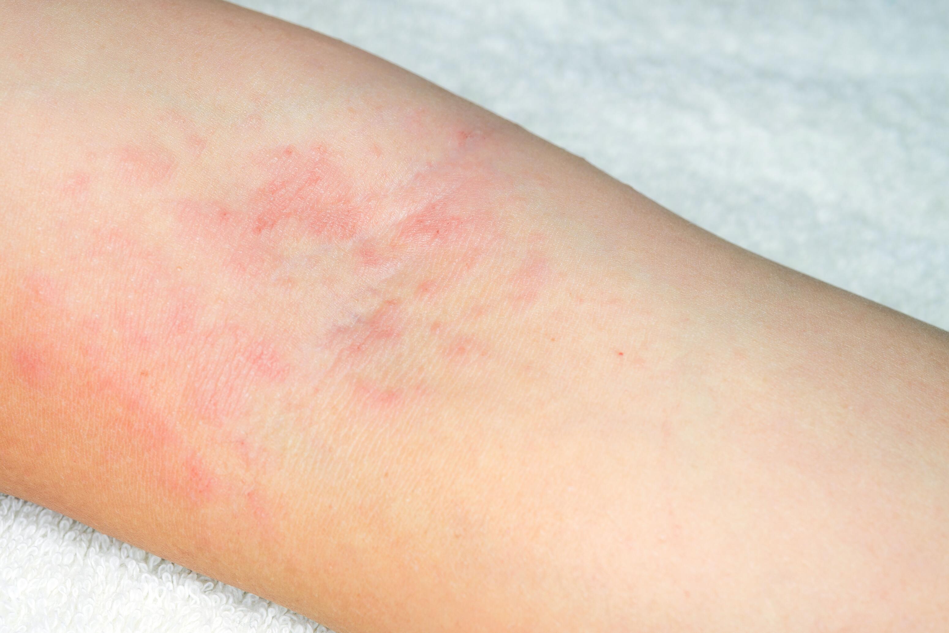 Eczema on Arms and Elbows: Managing Symptoms & Care for Folds