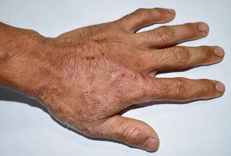 Hand with scabies lesions