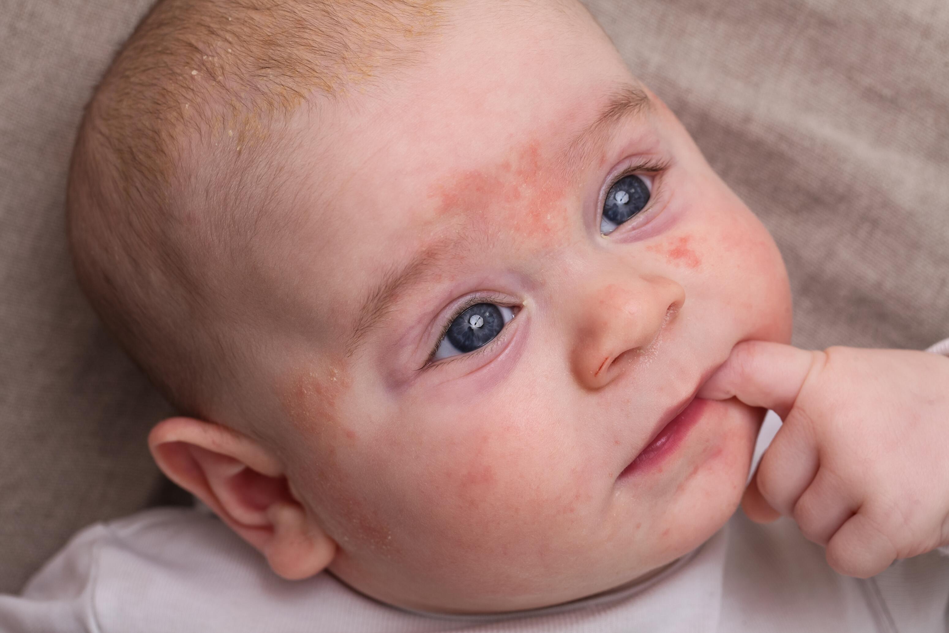 Infant with eczema on the face