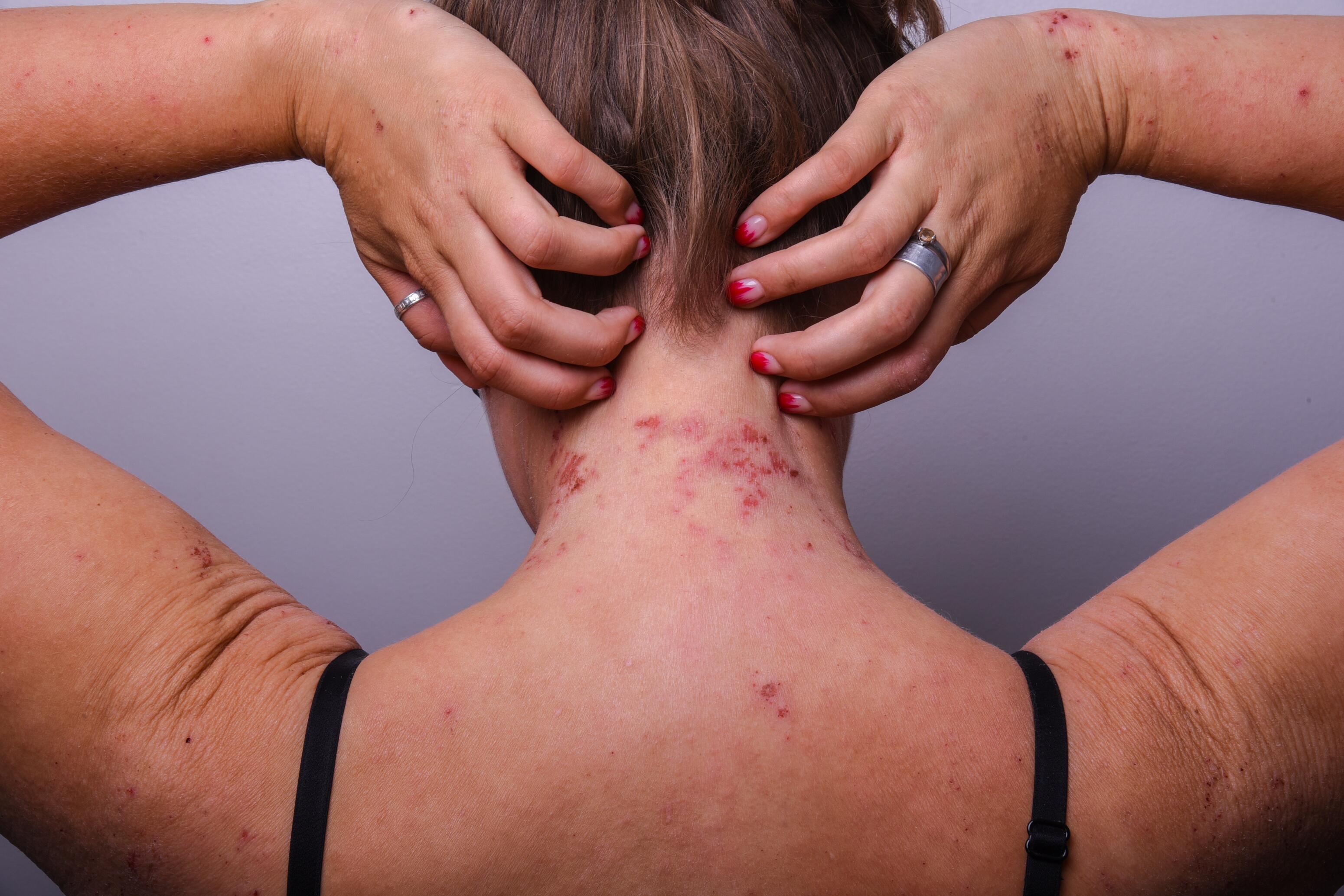 Woman with severe atopic dermatitis in the neck