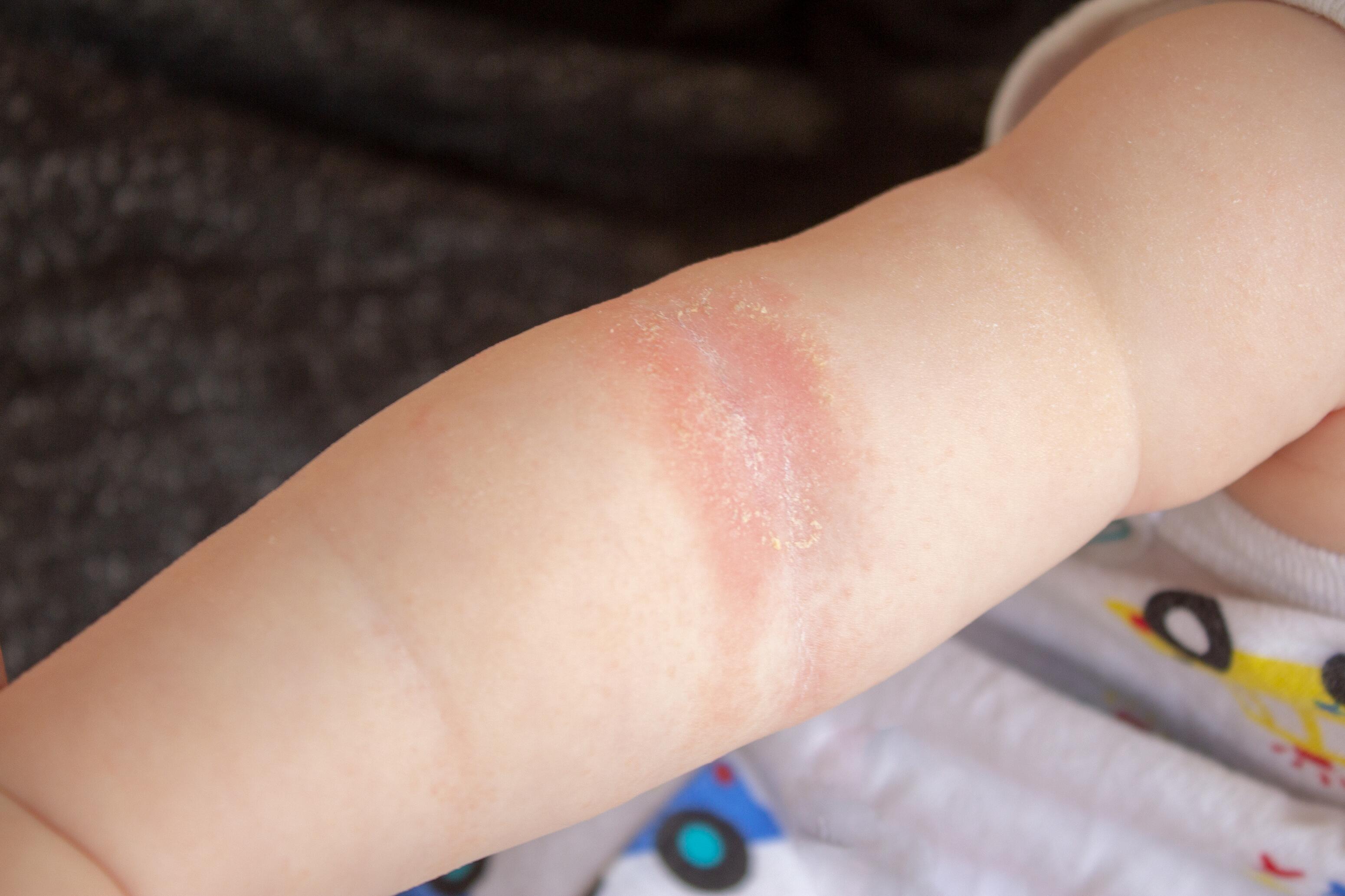 Infant with atopic eczema on the arm