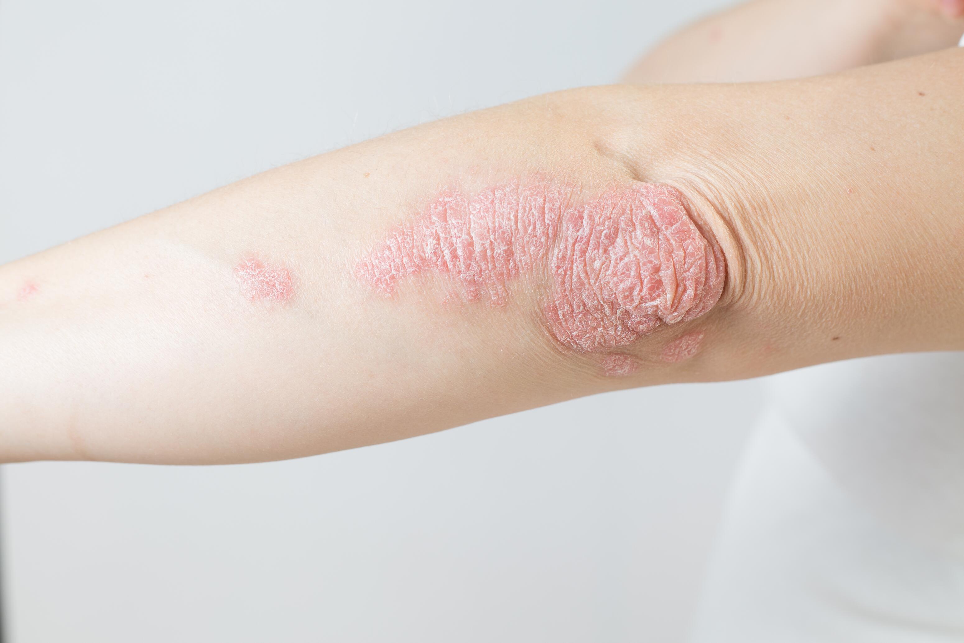 Arm with a psoriasis plaque on the elbow