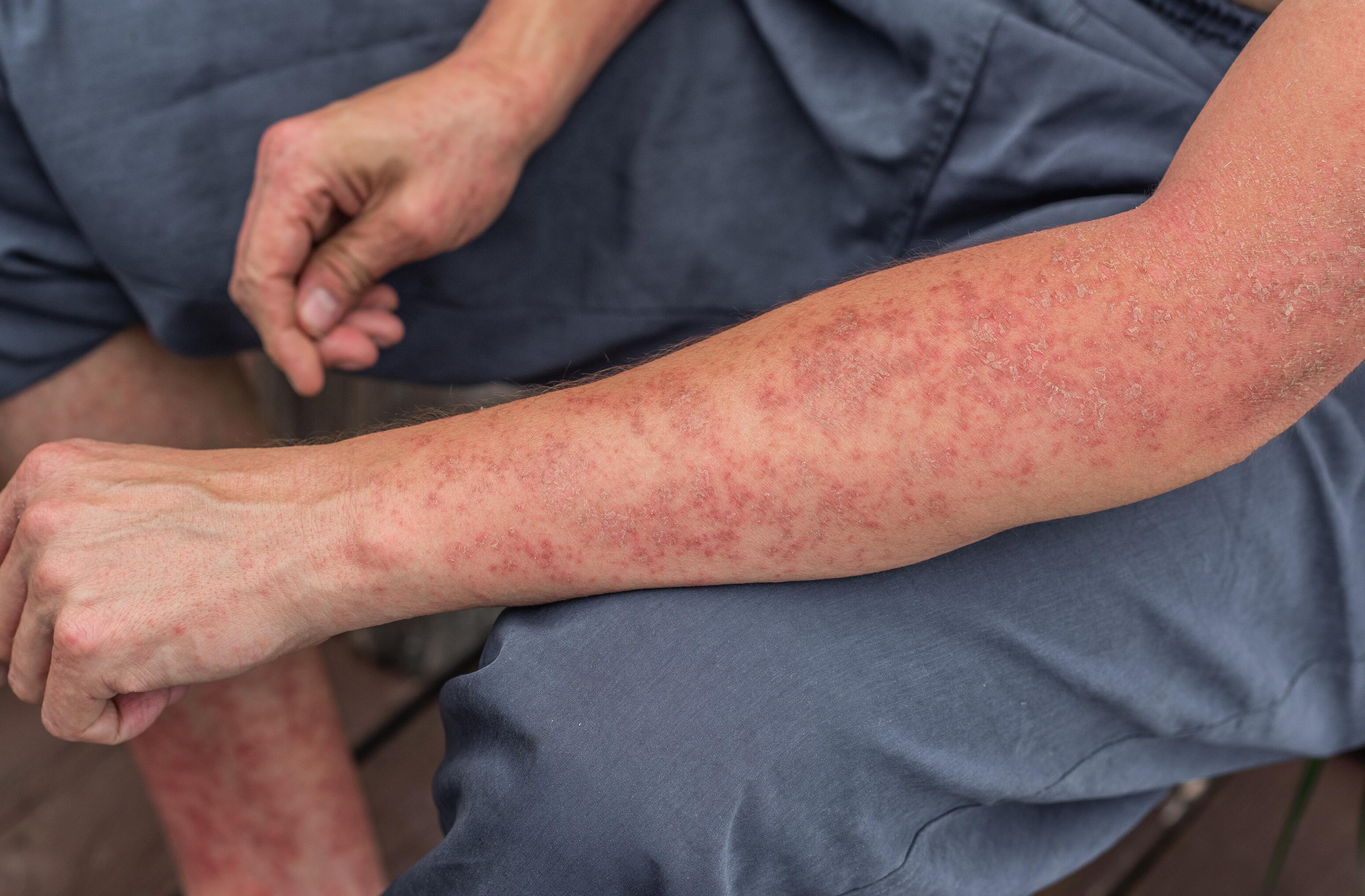 Man with eczema on arm and leg