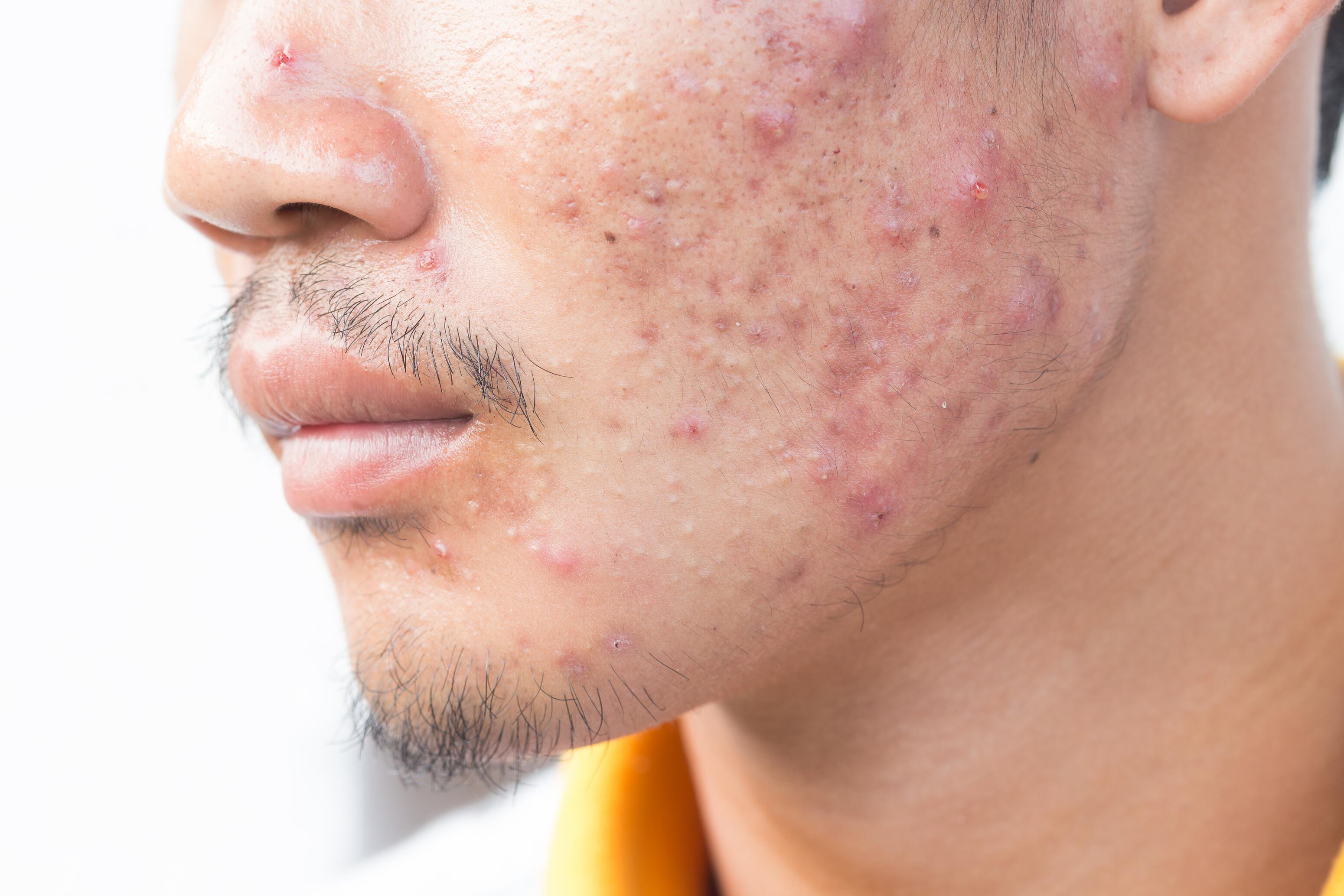 Men with acne on the face