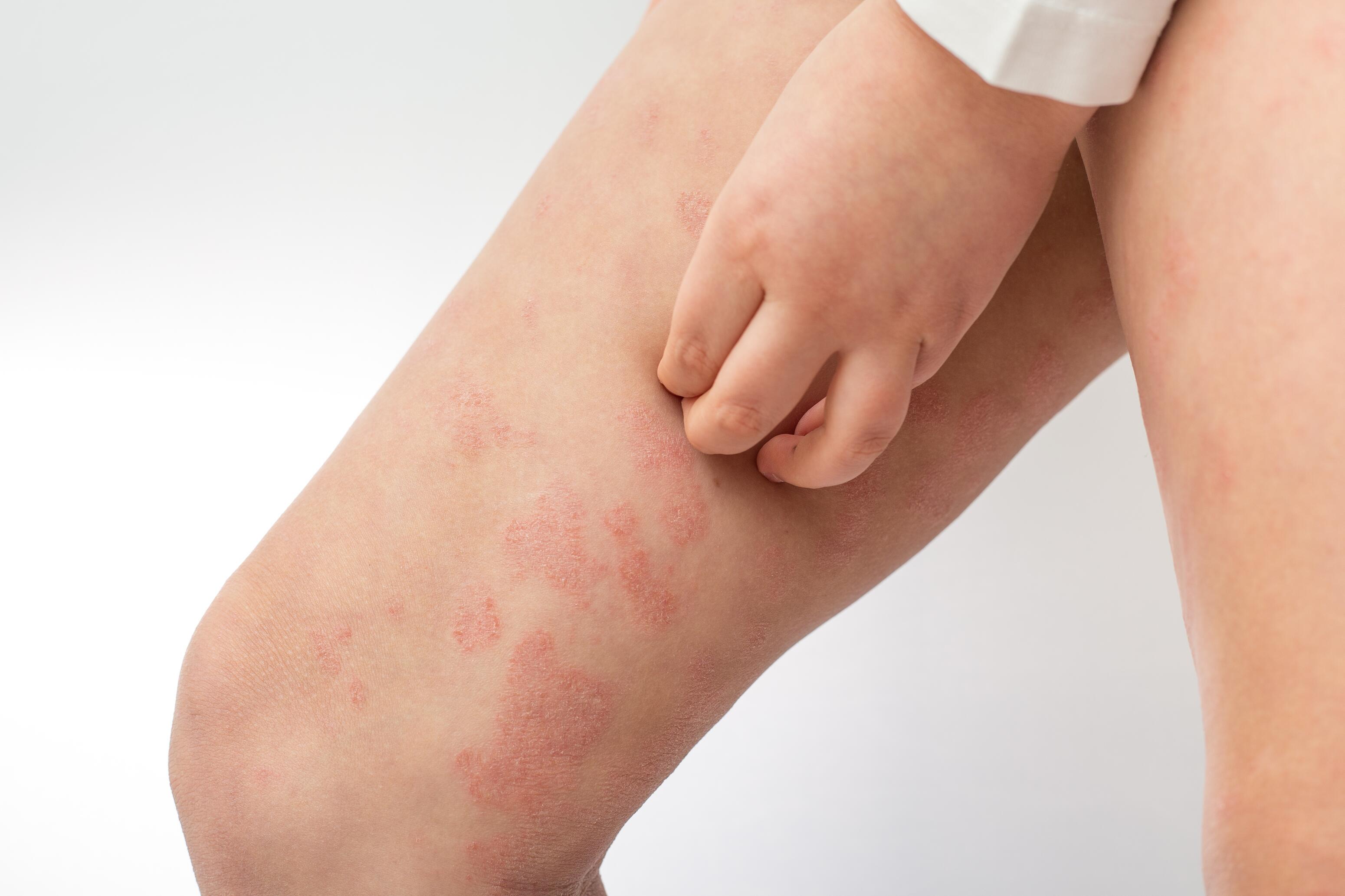 Teenager scratching his leg because of itching due to eczema