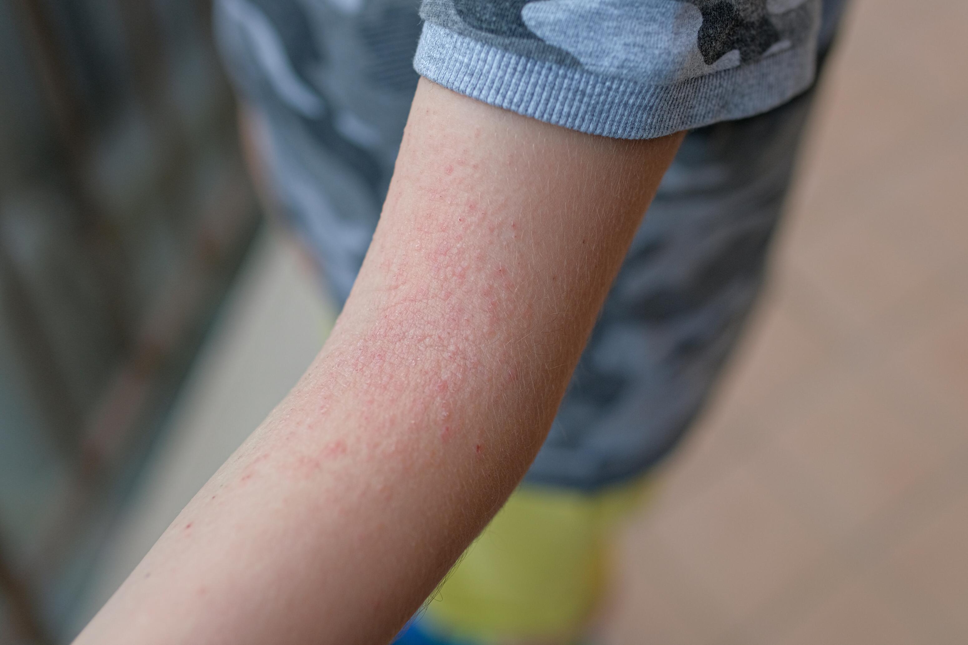 Child with atopic dermatitis on the arm