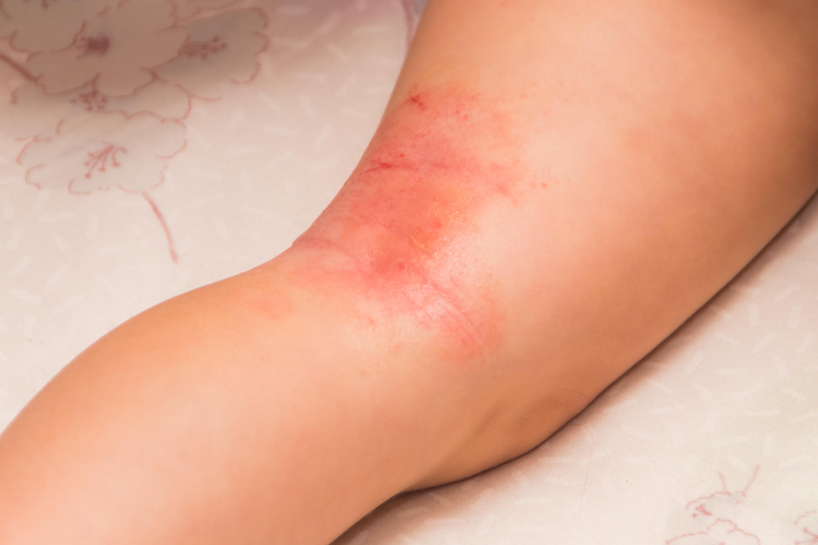 Leg with eczema lesions in the crease of the knee