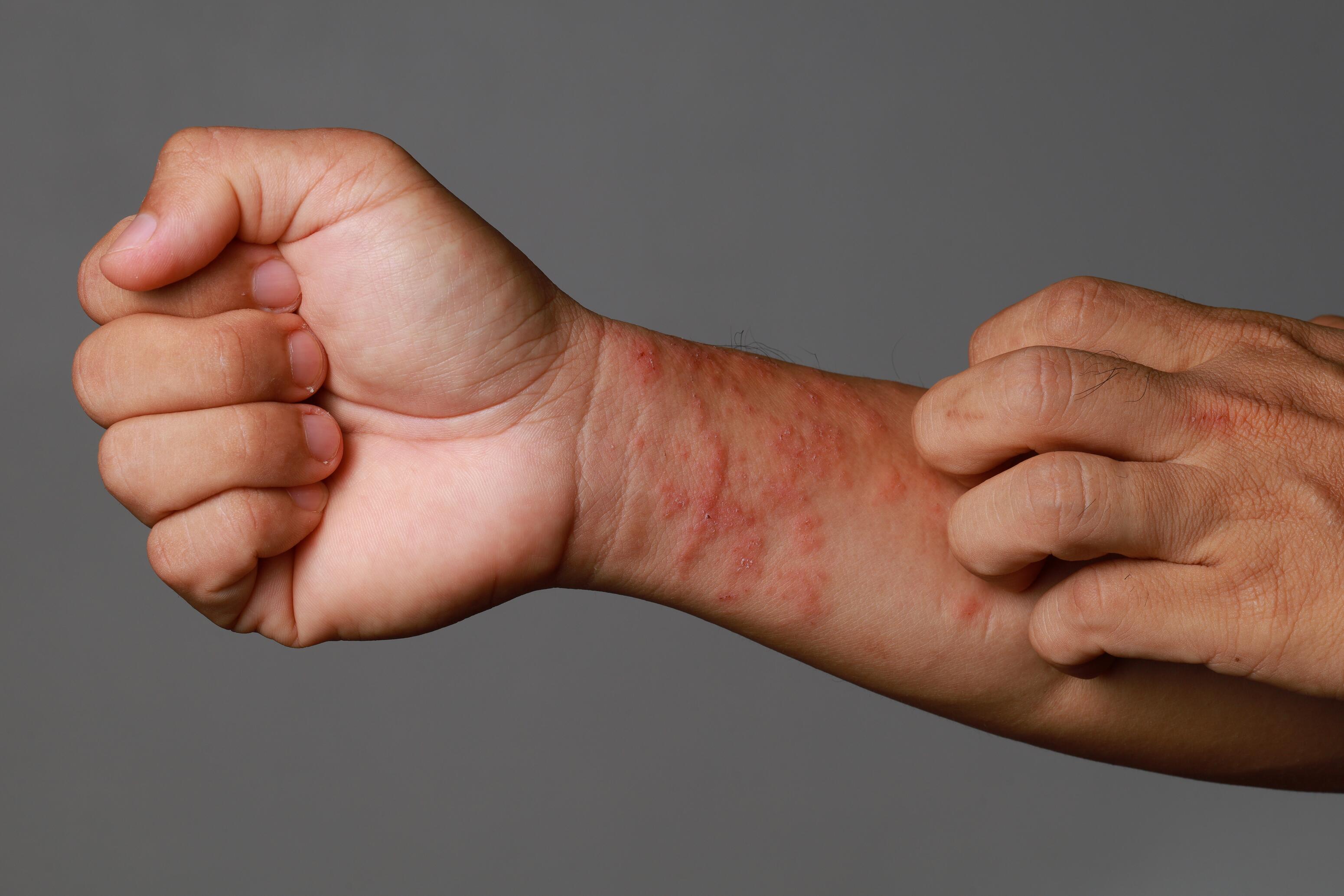 Dermatitis en manos y muñecas: síntomas, causas, tratamientos