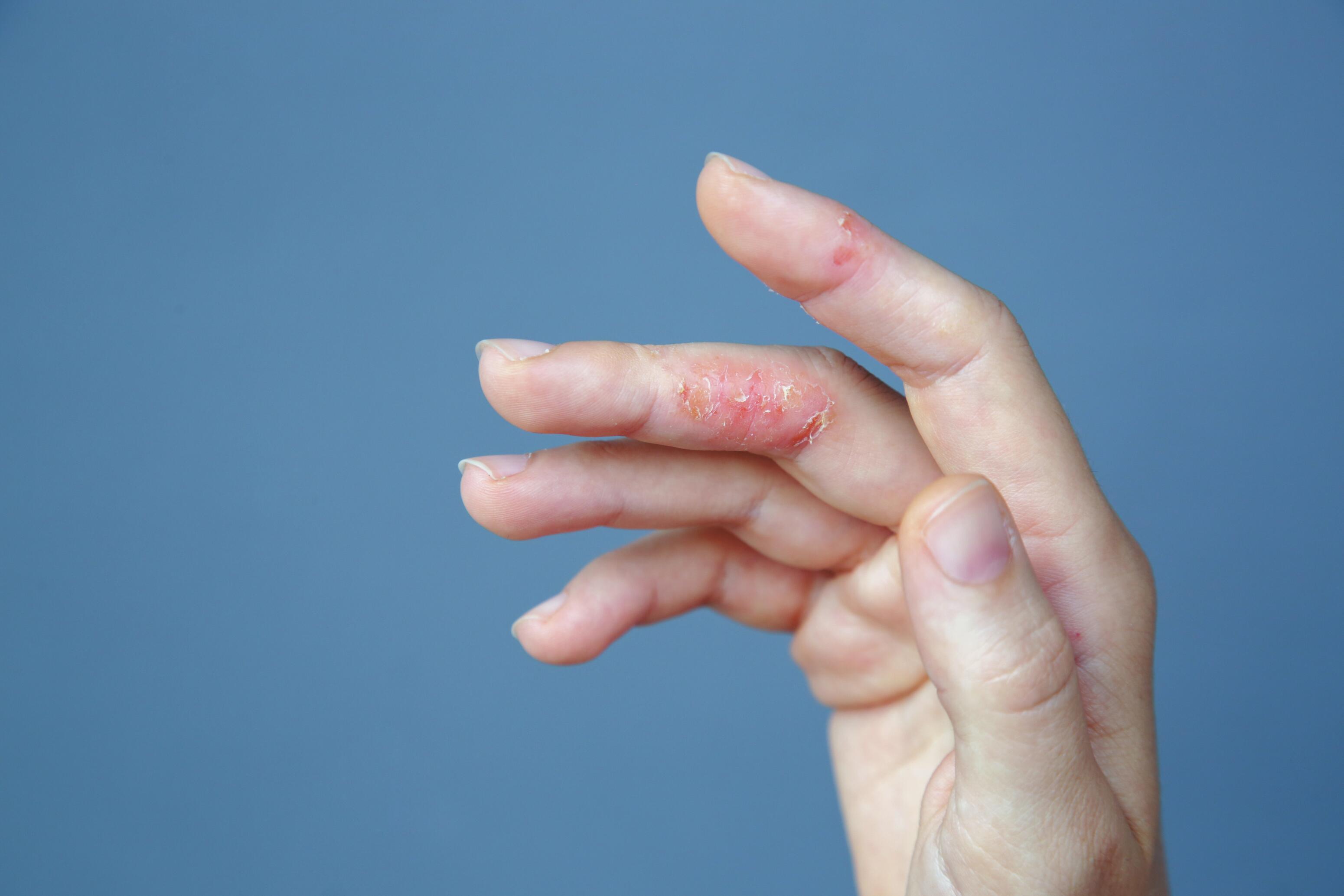 eczema-chronic-allergy-hand