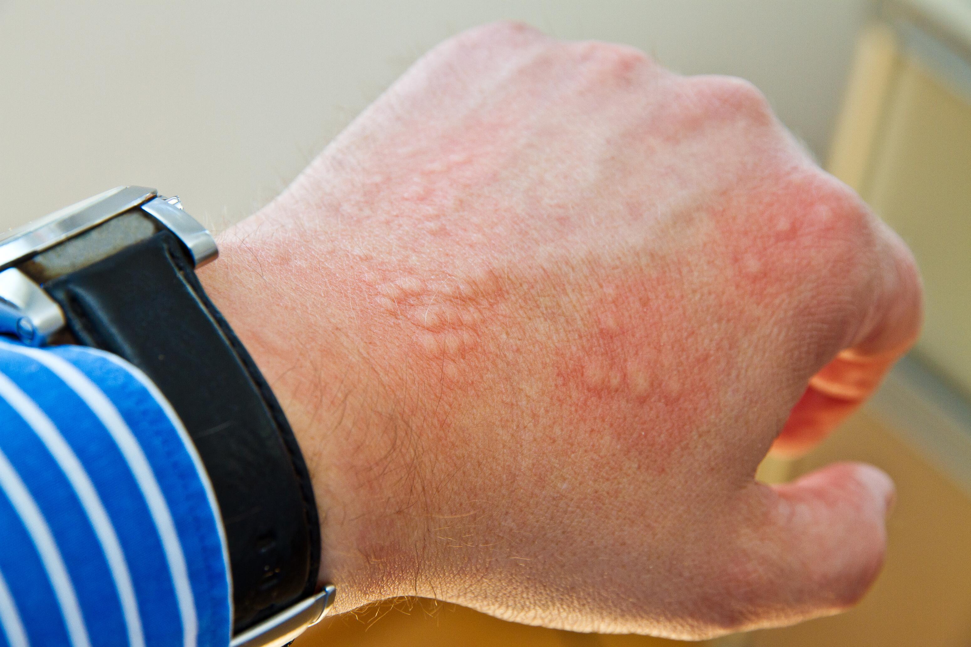 Hand with urticaria spots