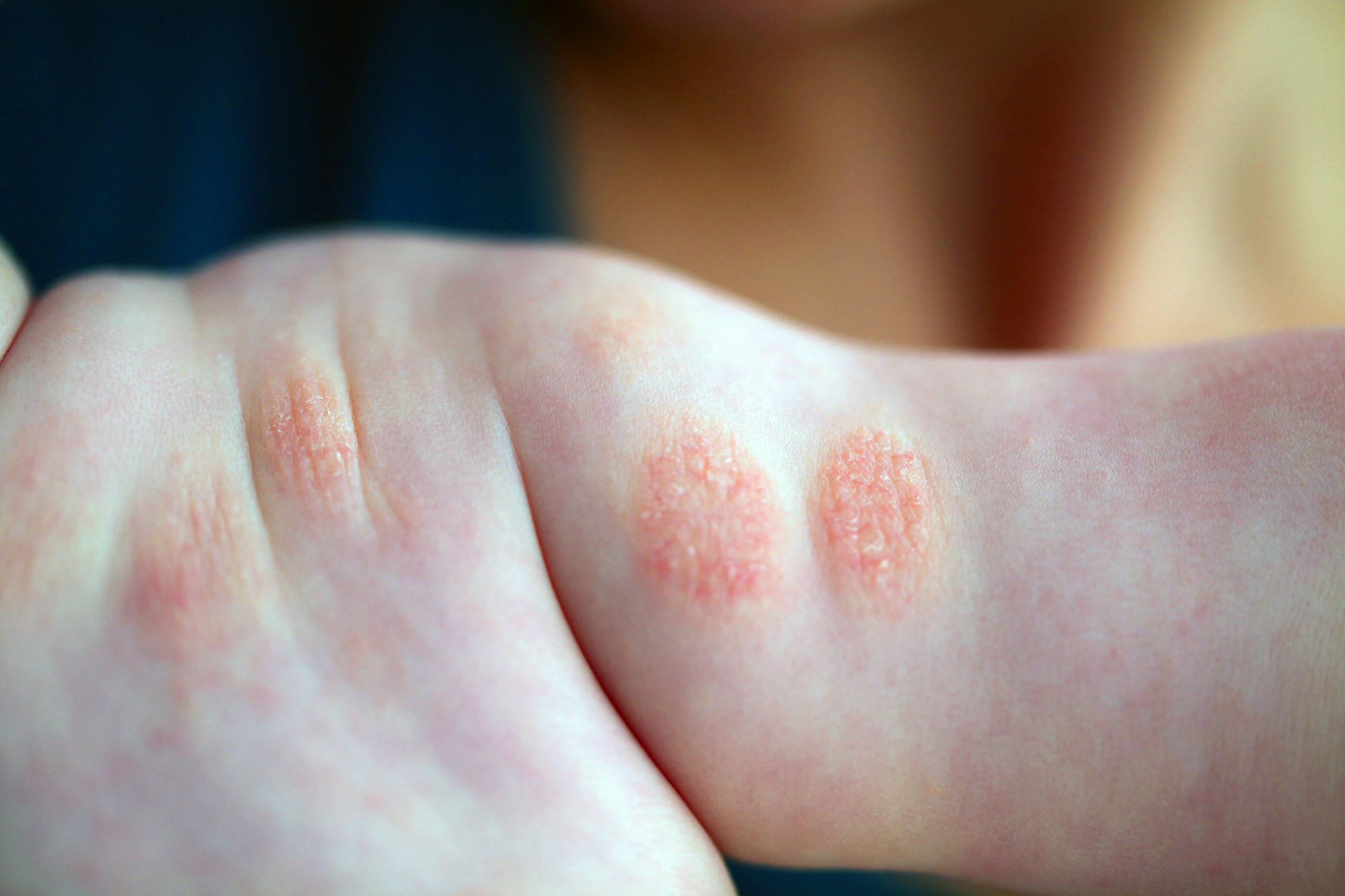 Child with red patches of nummular eczema