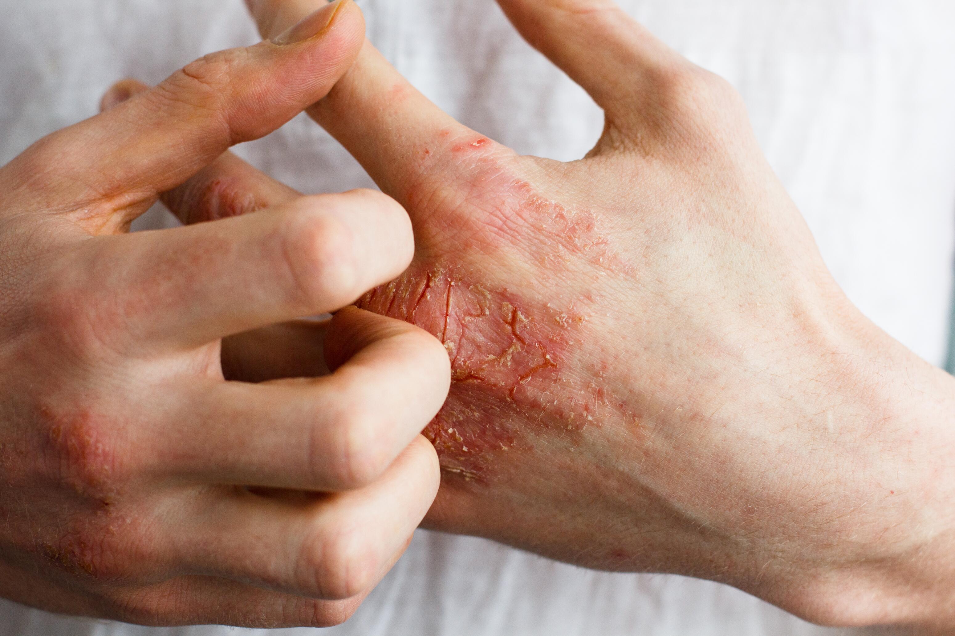 du_dexyane-med_silo_eczema_l1_p3-symptoms